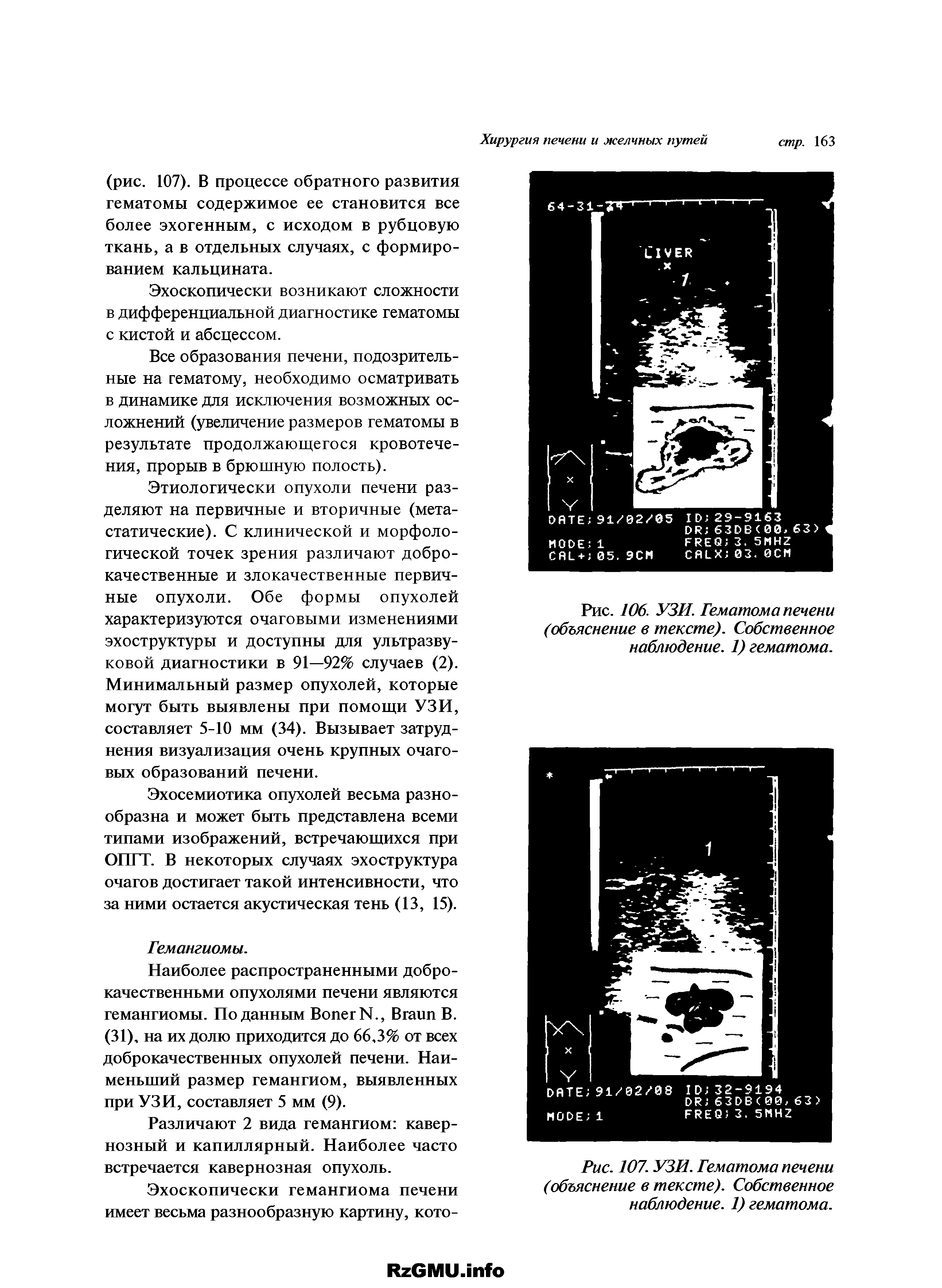 Рис. 106. УЗИ. Гематома печени (объяснение в тексте). Собственное наблюдение. 1) гематома.