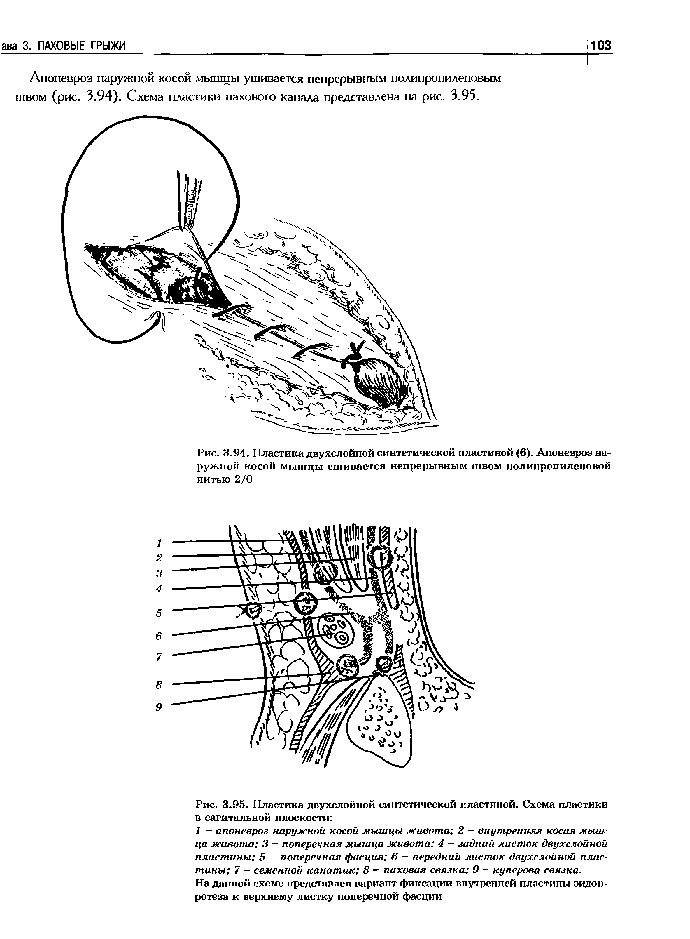 Рис. 3.94. Пластика двухслойной синтетической пластиной (6). Апоневроз наружной косой мышцы сшивается непрерывным швом полипропиленовой нитью 2/0...