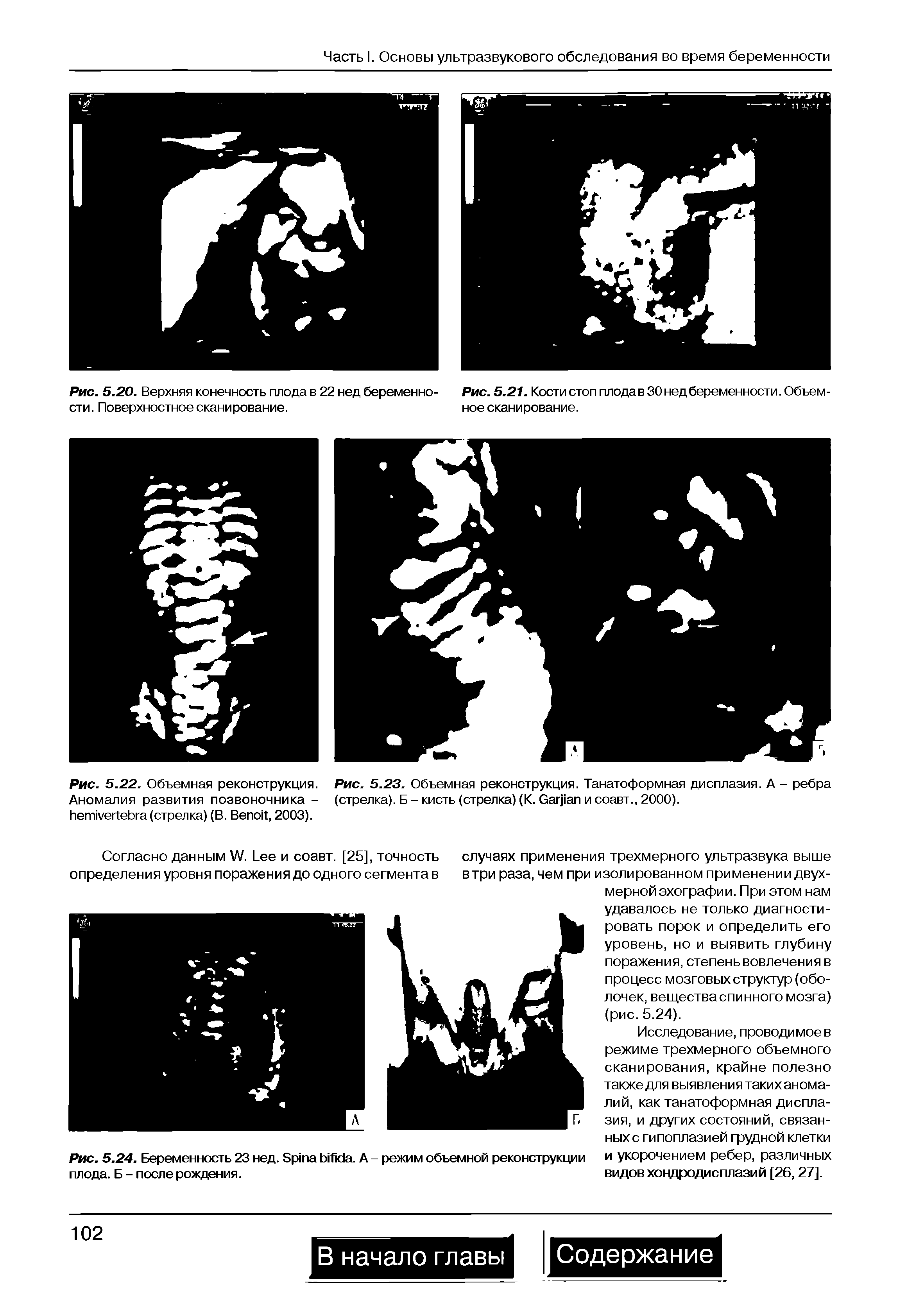 Рис. 5.23. Объемная реконструкция. Танатоформная дисплазия. А - ребра (стрелка). Б - кисть (стрелка) (К. Саграп и соавт., 2000).