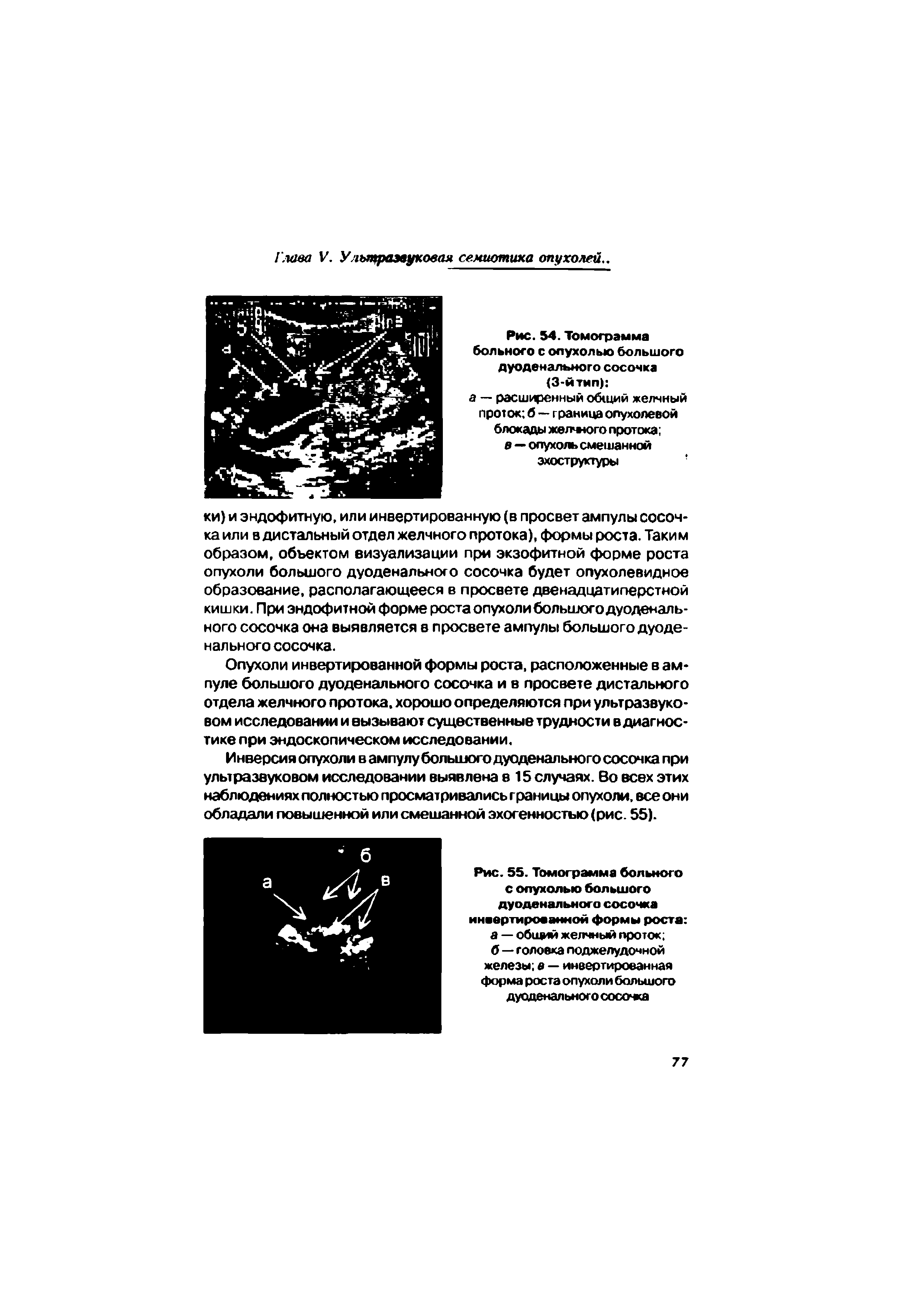 Рис. 54. Томограмма больного с опухолью большого дуоденального сосочка (3-й тип) ...