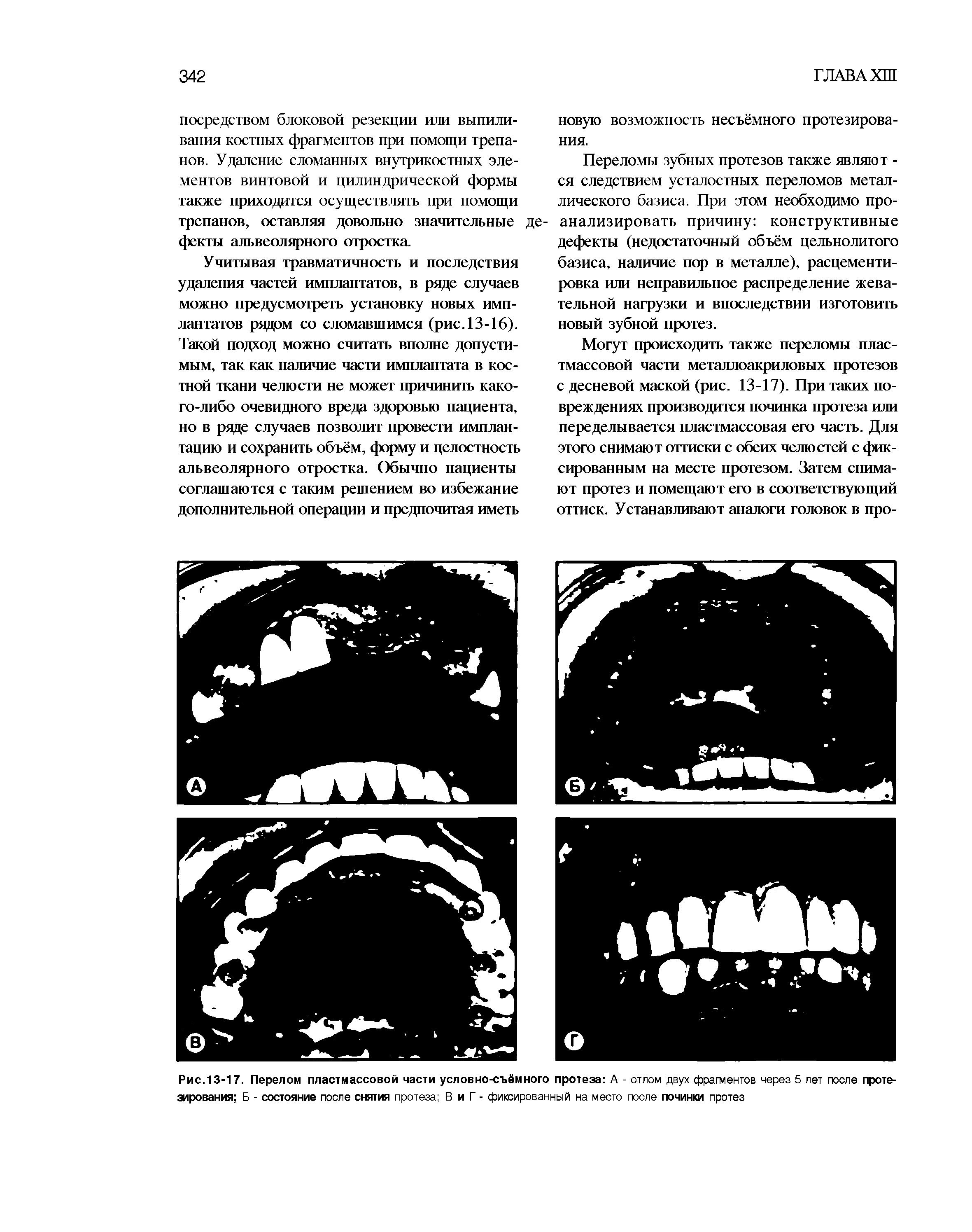 Рис.13-17. Перелом пластмассовой части условно-съёмного протеза А - отлом двух фрагментов через 5 лет после проте-зирования Б - состояние после снятия протеза В и Г - фиксированный на место после починки протез...