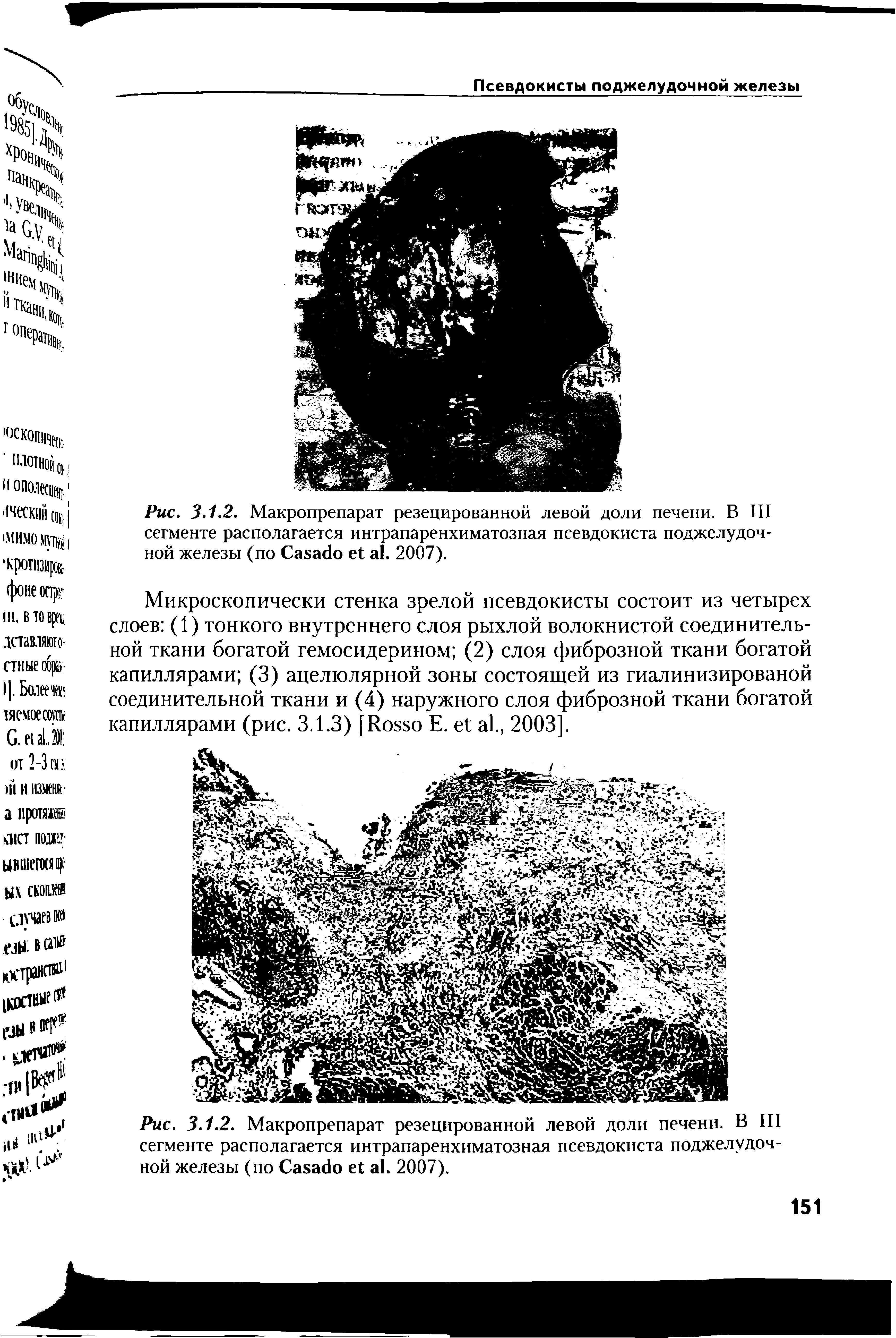 Рис. 3.1.2. Макропрепарат резецированной левой доли печени. В III сегменте располагается интрапаренхиматозная псевдокиста поджелудочной железы (по C . 2007).