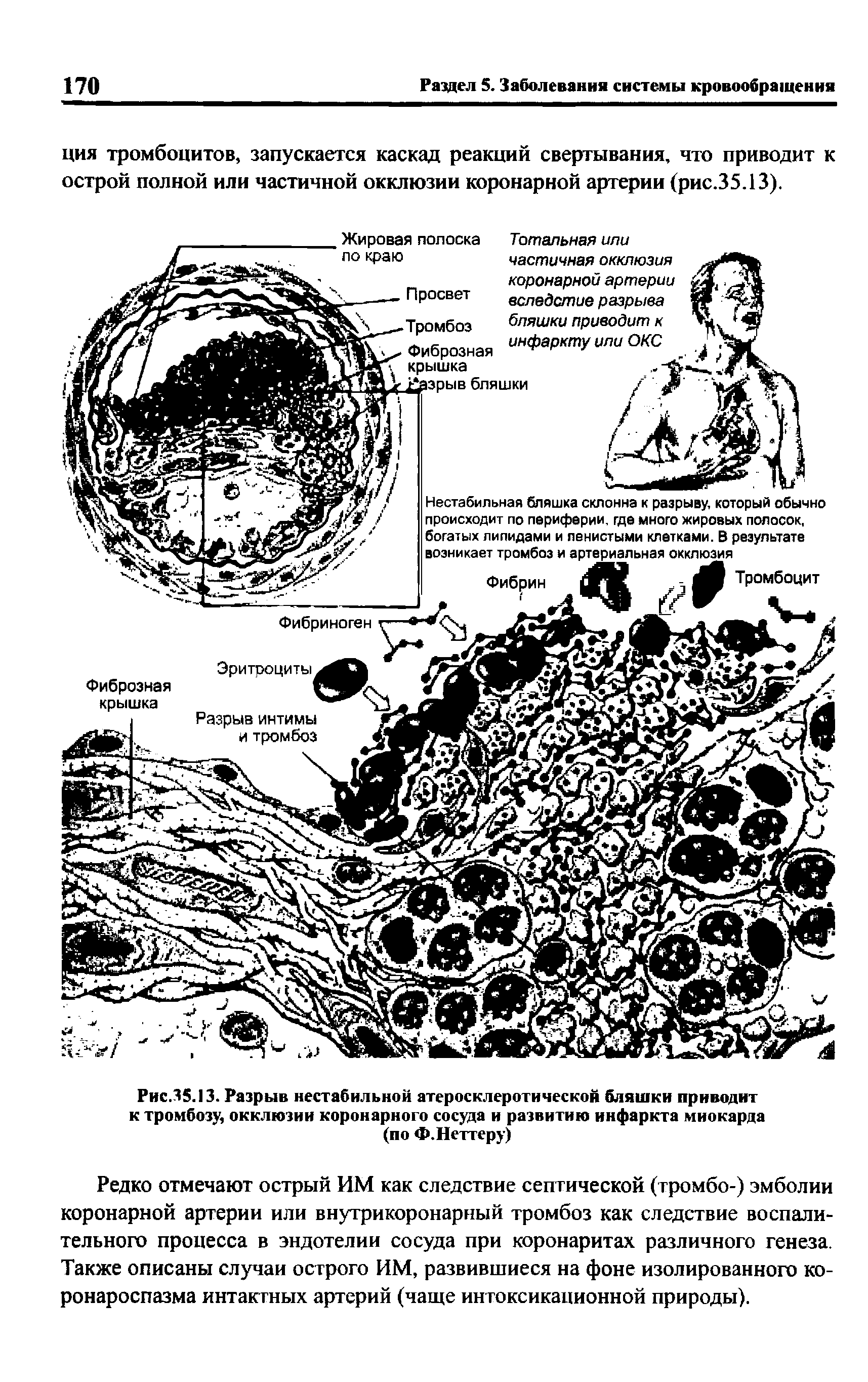 Рис.35.13. Разрыв нестабильной атеросклеротической бляшки приводит к тромбозу, окклюзии коронарного сосуда и развитию инфаркта миокарда (по Ф.Неттеру)...