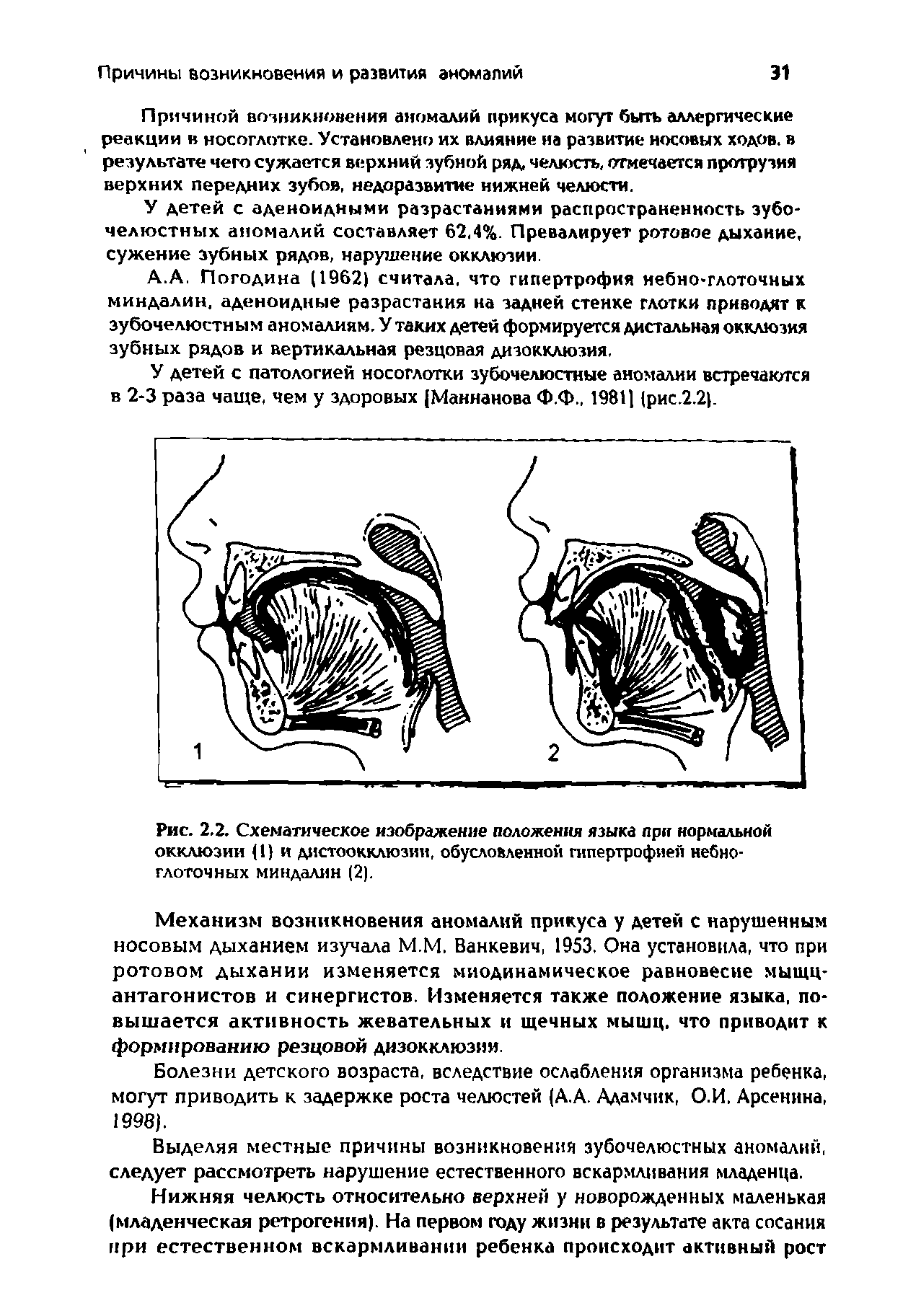 Рис. 2.2. Схематическое изображение положения языка при нормальной окклюзии (1) и дистоокклюзии, обусловленной гипертрофией небно-глоточных миндалин (2).