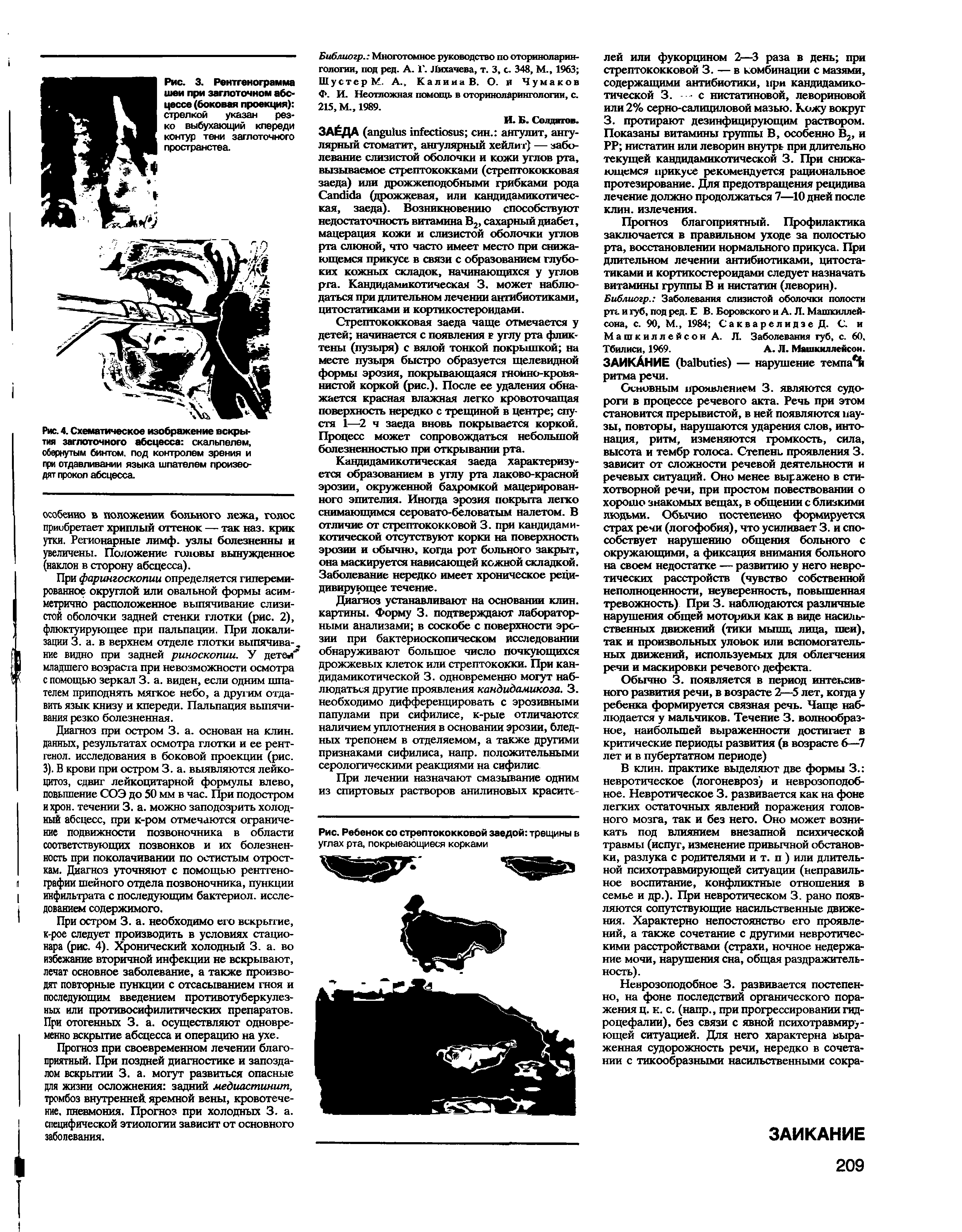 Рис. Ребенок со стрептококковой заедой трещины в углах рта, покрывающиеся корками...