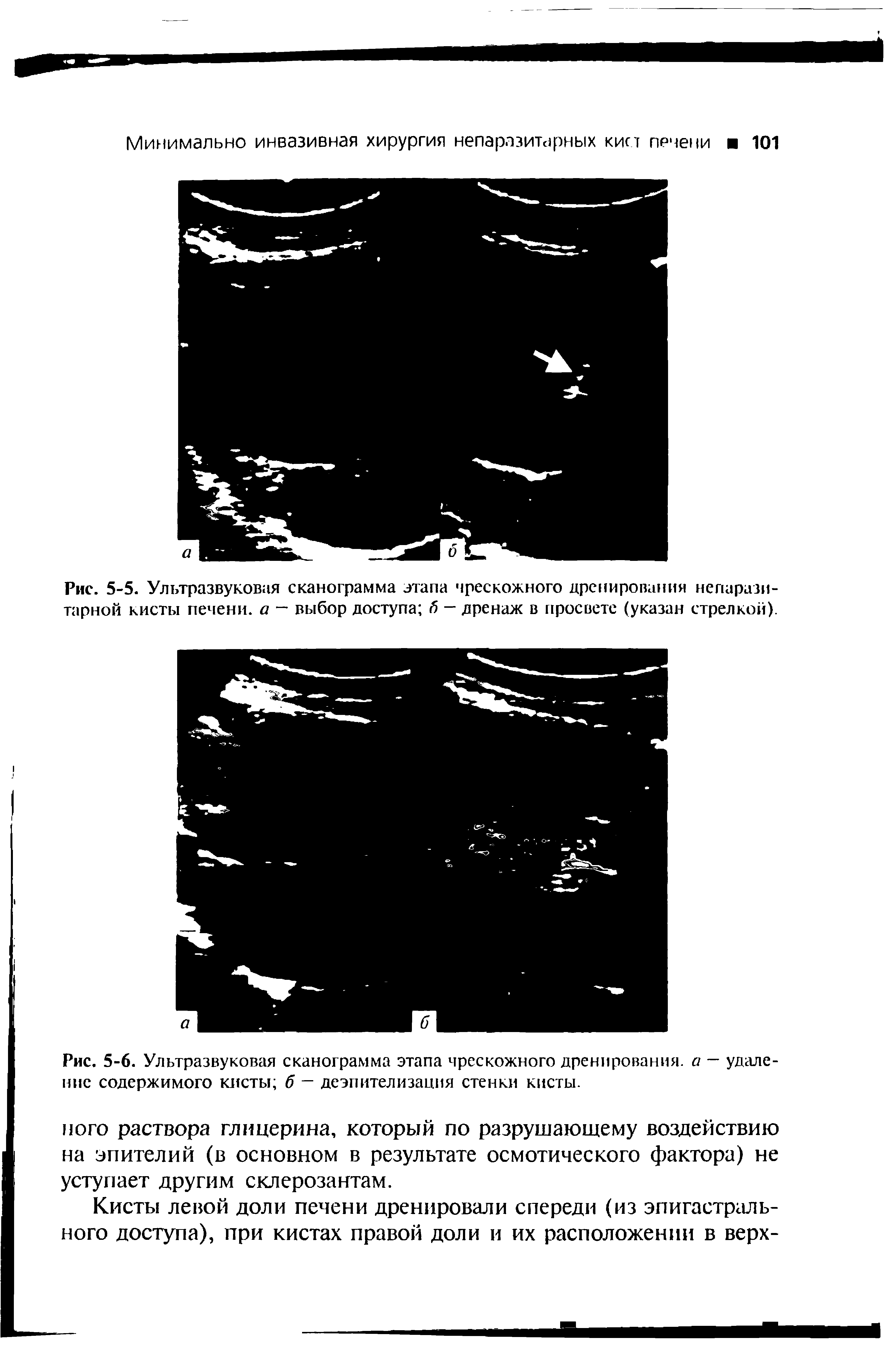 Рис. 5-5. Ультразвуковая сканограмма этапа чрескожного дренирования непаразитарной кисты печени, а — выбор доступа б — дренаж в просвете (указан стрелкой).