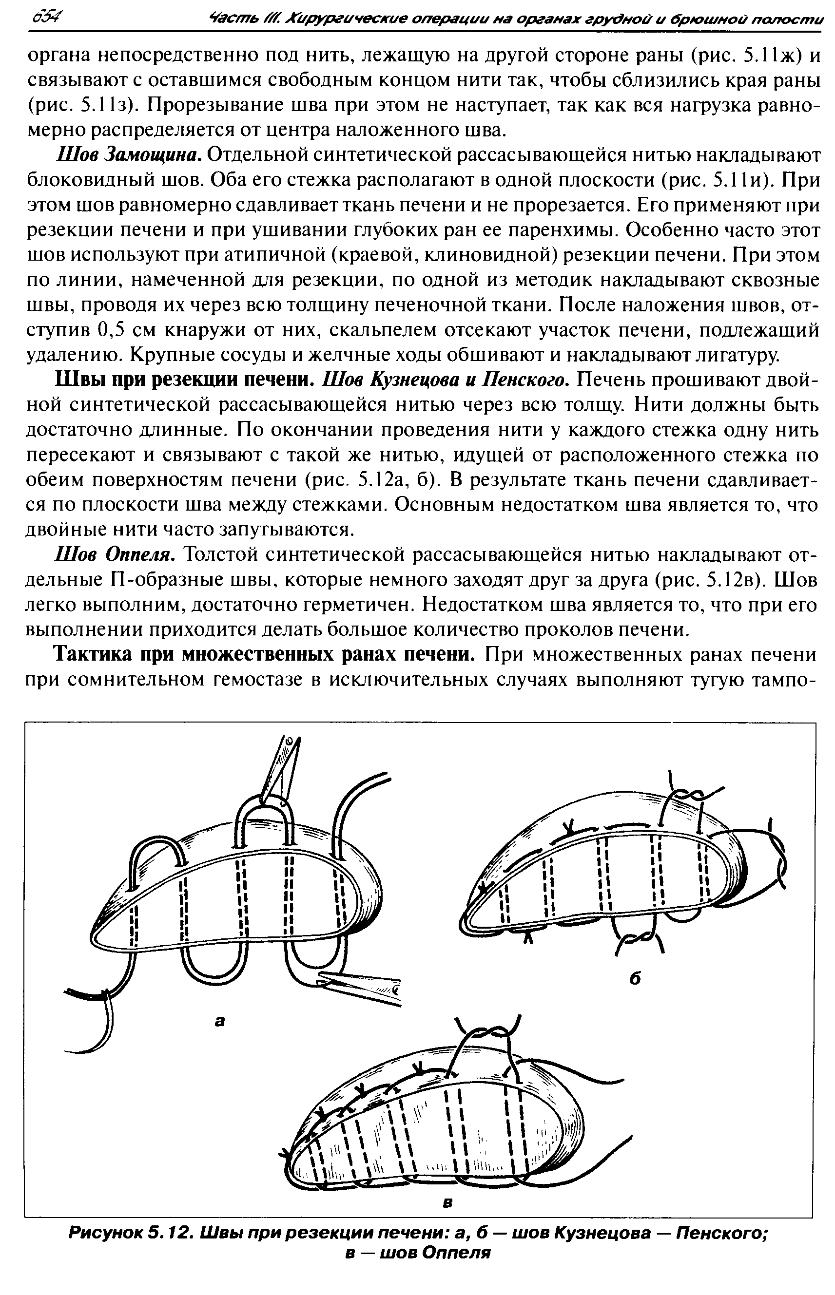 Рисунок 5.12. Швы при резекции печени а, б — шов Кузнецова — Пенского в — шов Оппеля...