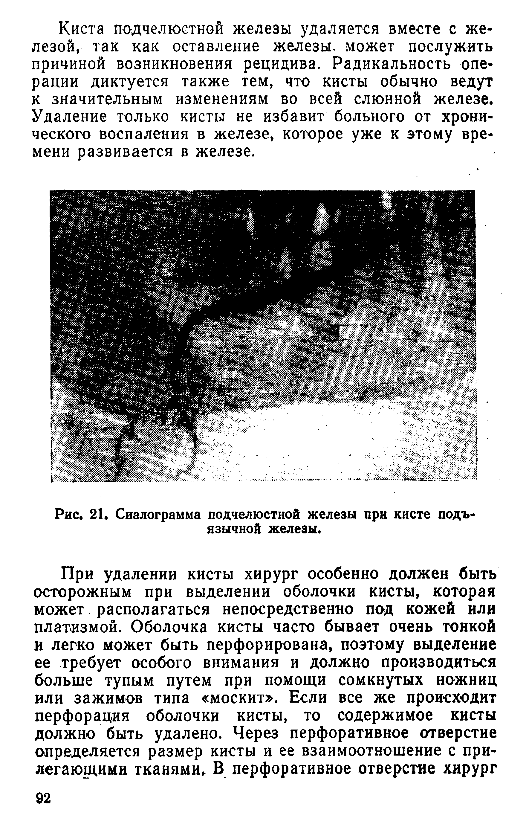 Рис. 21. Сиалограмма подчелюстной железы при кисте подъязычной железы.