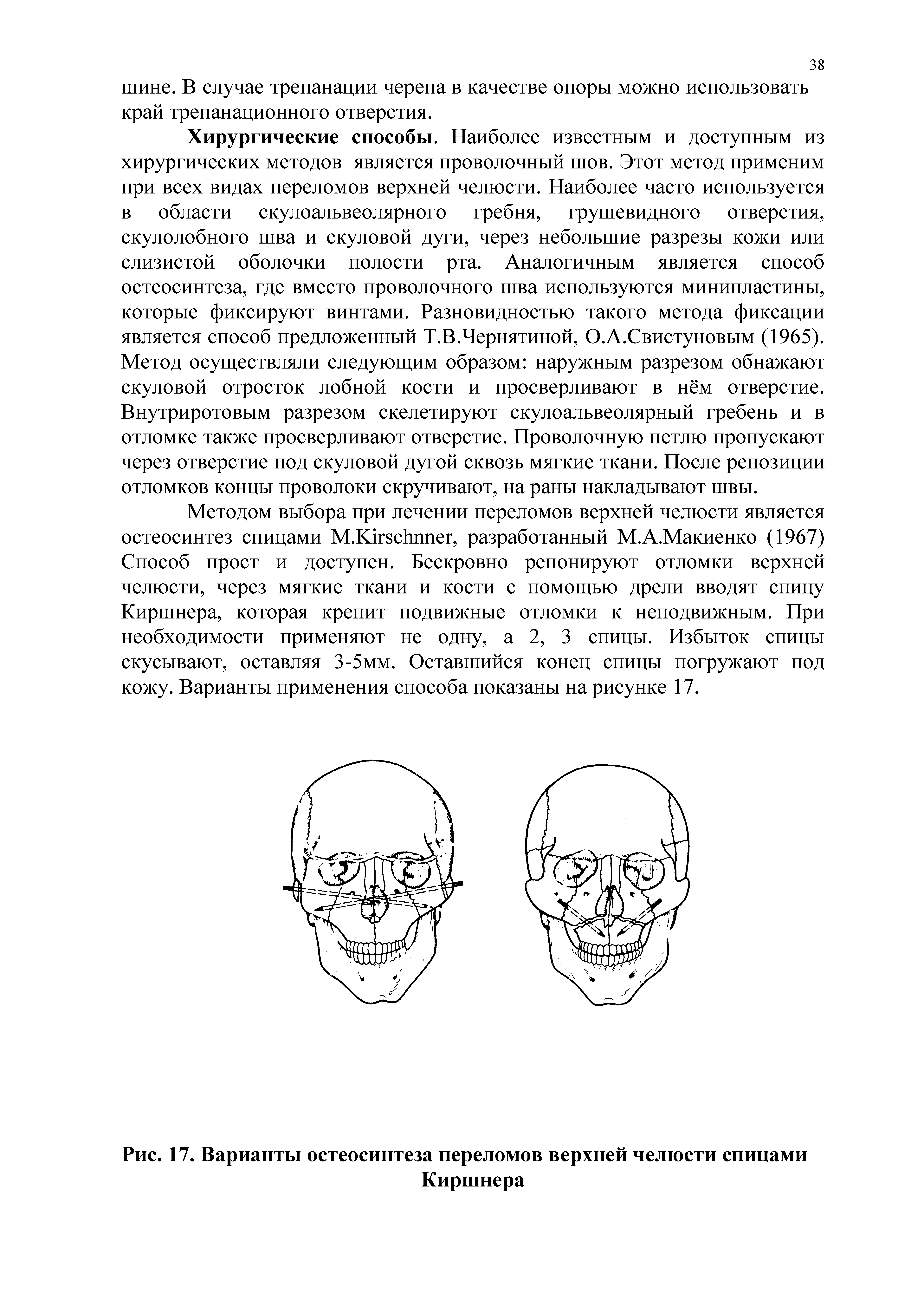 Рис. 17. Варианты остеосинтеза переломов верхней челюсти спицами Киршнера...