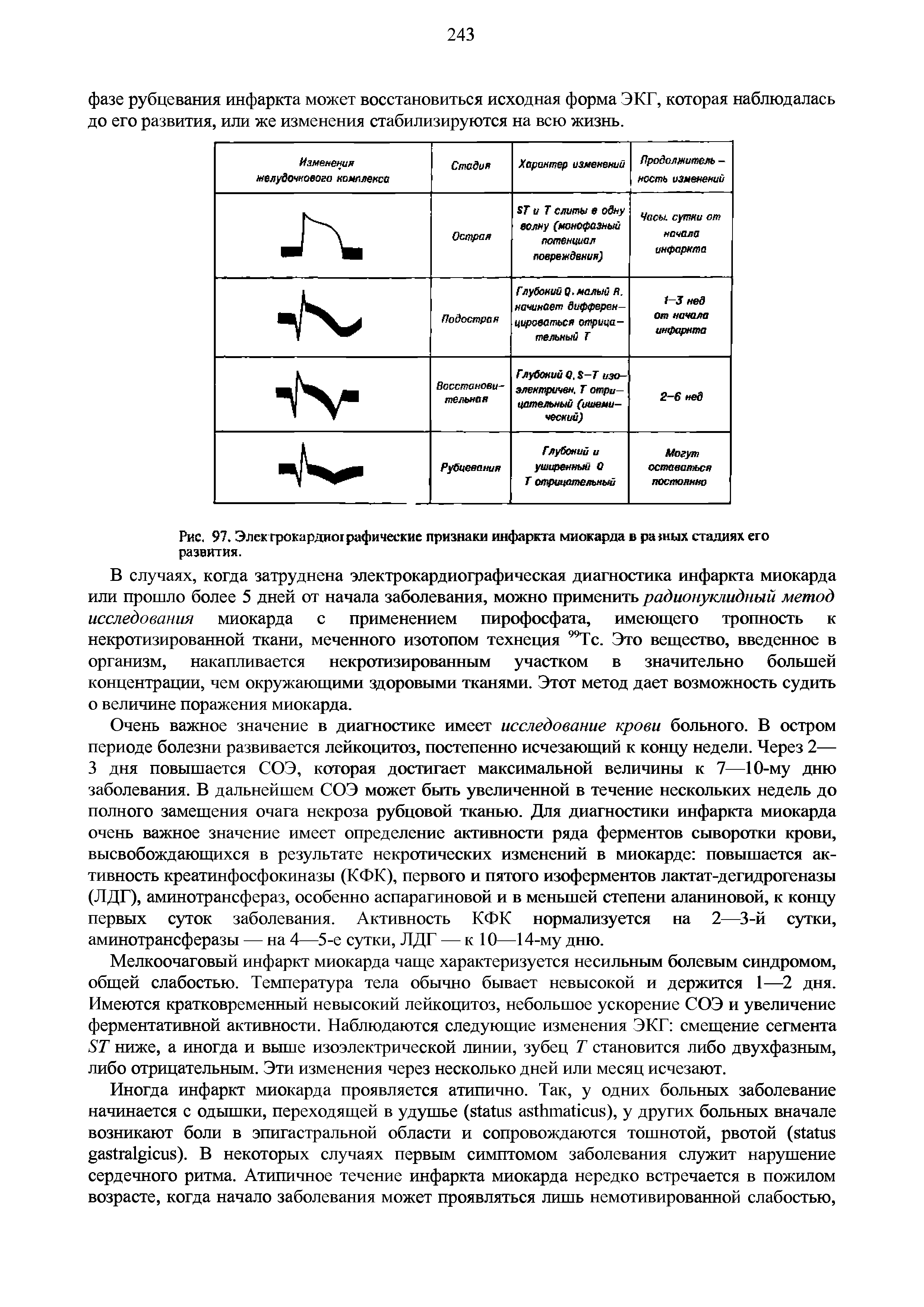 Рис. 97. Электрокардиографические признаки инфаркта миокарда в разных стадиях его развития.