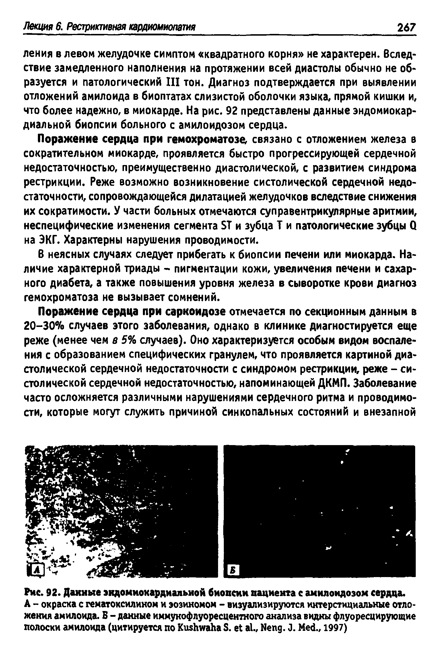 Рис. 92. Данные эндомиокардиальной биопсии пациента с амилоидозом сердца.