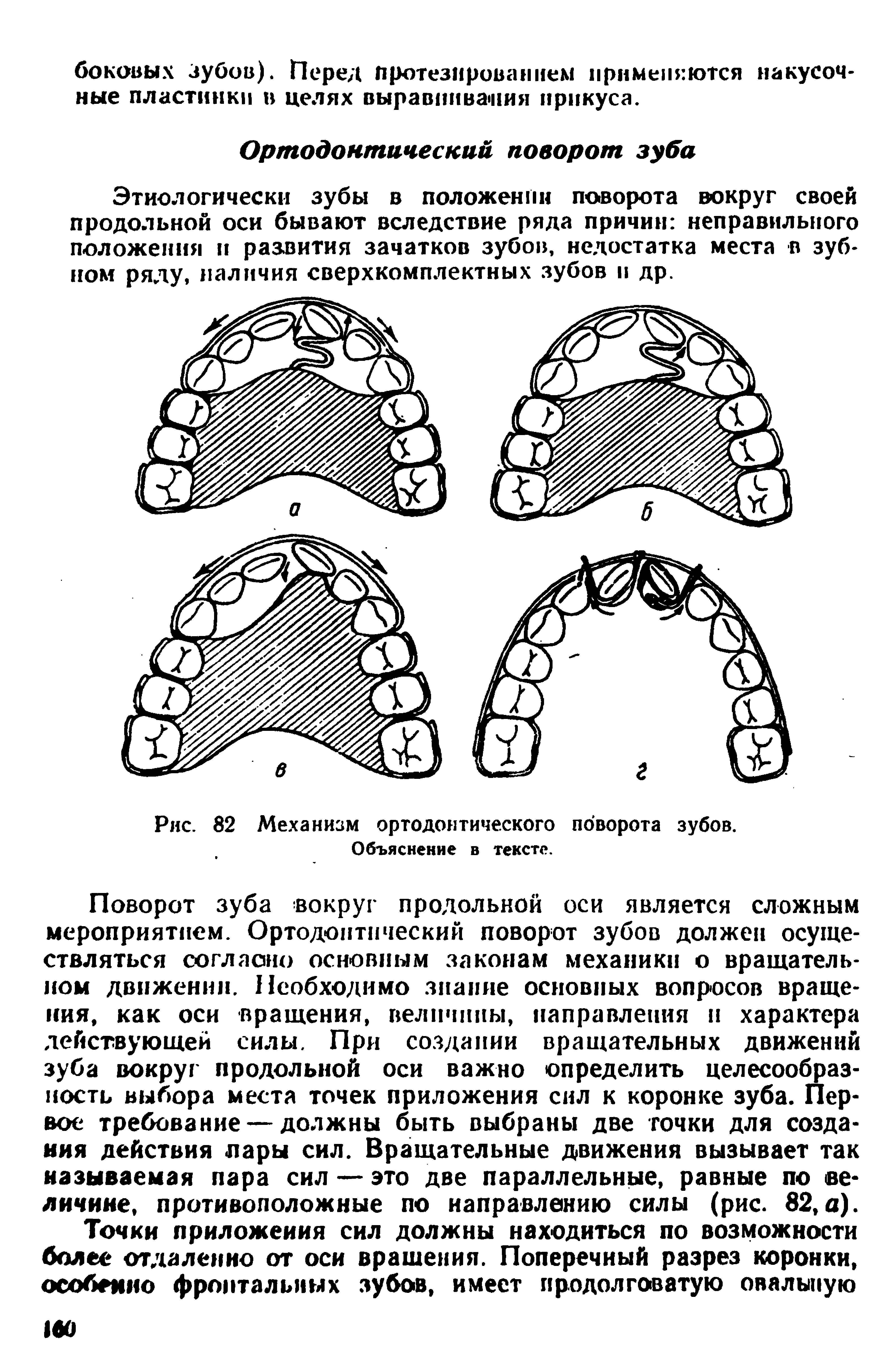 Рис. 82 Механизм ортодонтического поворота зубов. Объяснение в тексте.