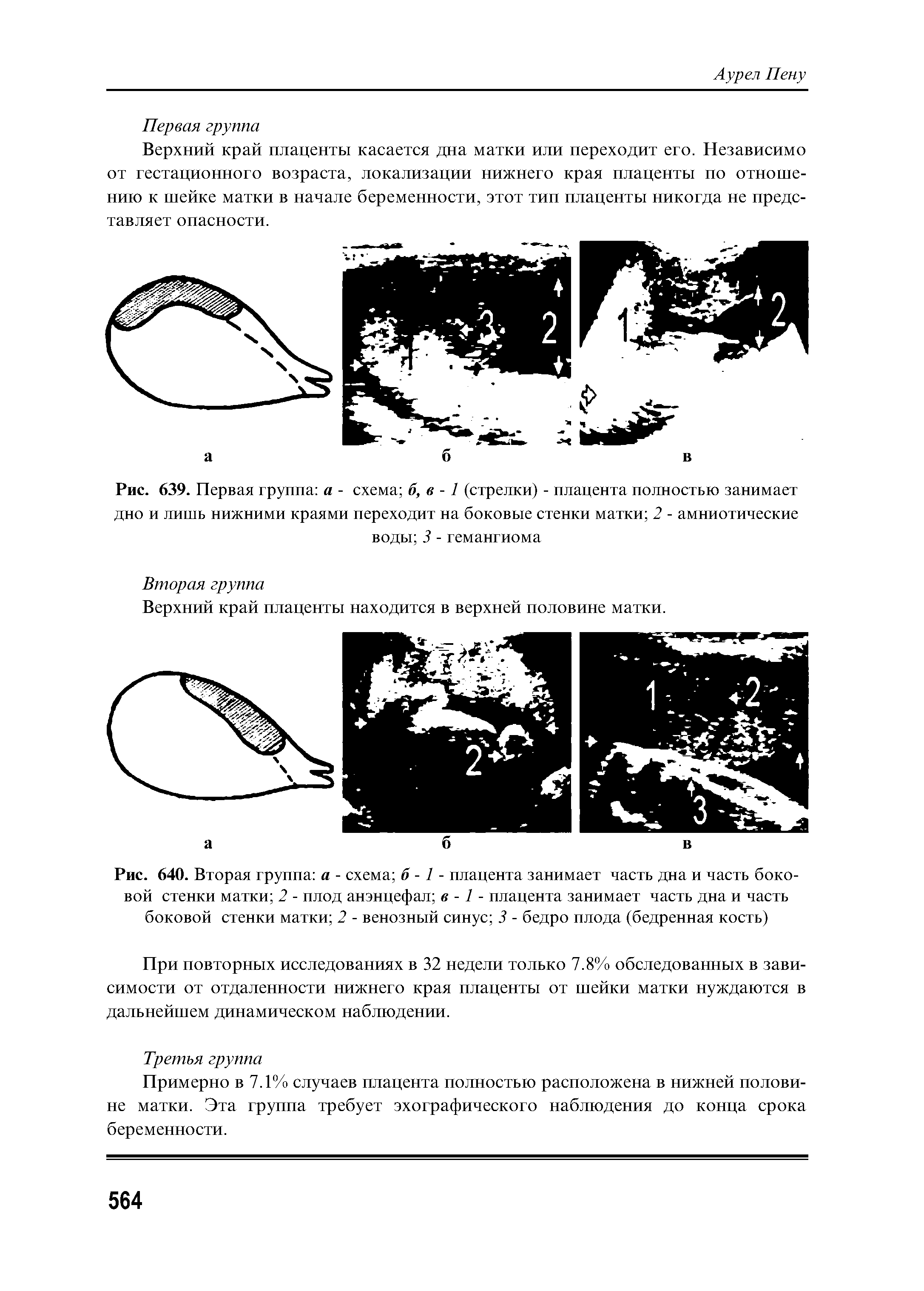 Рис. 640. Вторая группа а - схема б -1 - плацента занимает часть дна и часть боковой стенки матки 2 - плод анэнцефал в -1 - плацента занимает часть дна и часть боковой стенки матки 2 - венозный синус 3 - бедро плода (бедренная кость)...