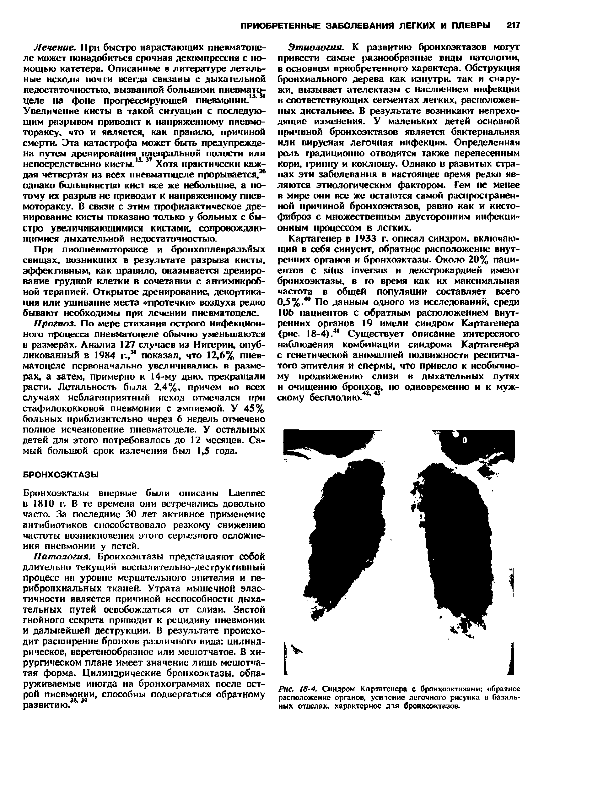 Рис. 18-4. Синдром Картагенера с бронхоэктазами обратное расположение органов, усн пение легочного рисунка в базальных отделах, характерное для бронхоэктазов.