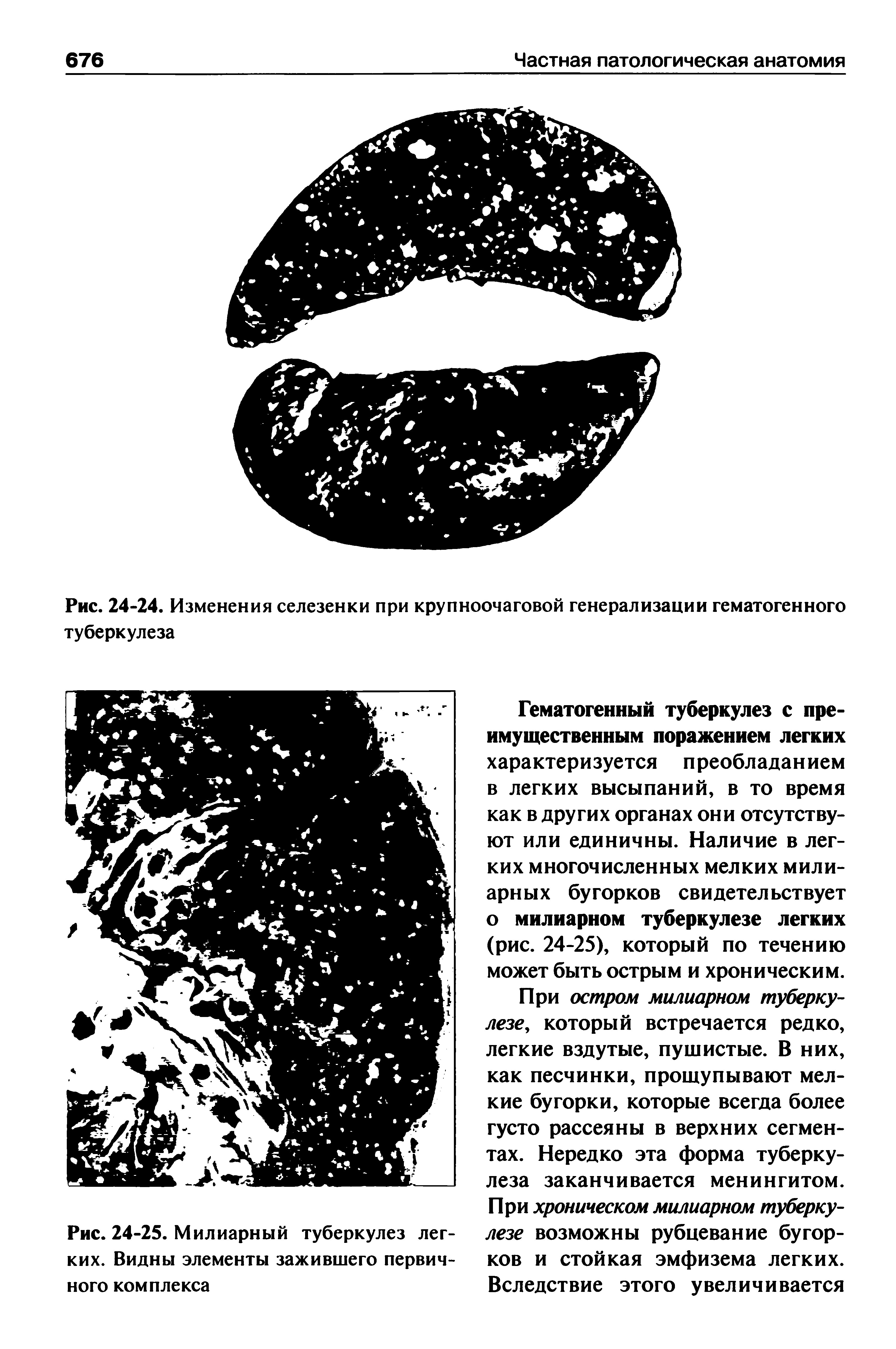 Рис. 24-25. Милиарный туберкулез легких. Видны элементы зажившего первичного комплекса...