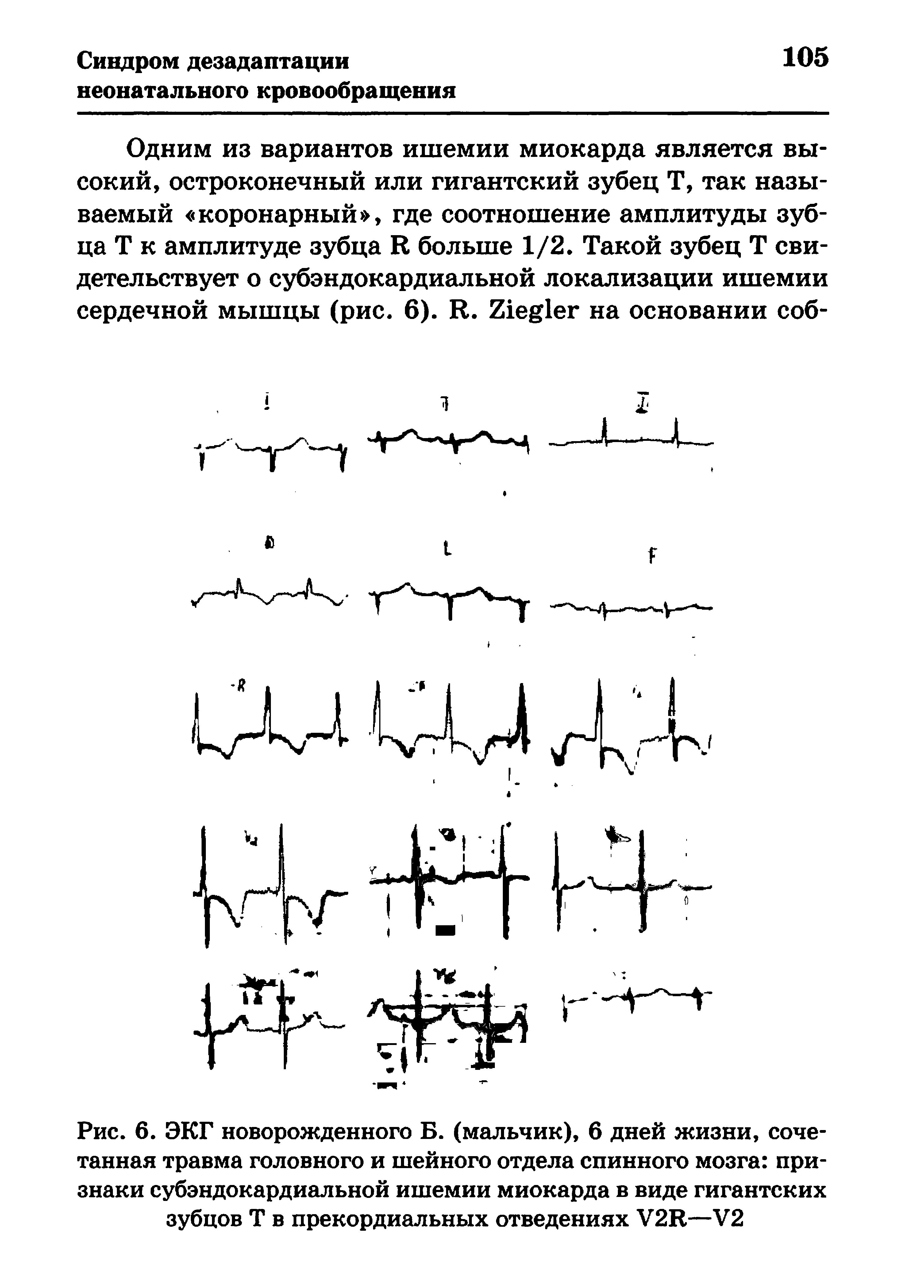 Рис. 6. ЭКГ новорожденного Б. (мальчик), 6 дней жизни, сочетанная травма головного и шейного отдела спинного мозга признаки субэндокардиальной ишемии миокарда в виде гигантских зубцов Т в прекордиальных отведениях У2Б—У2...