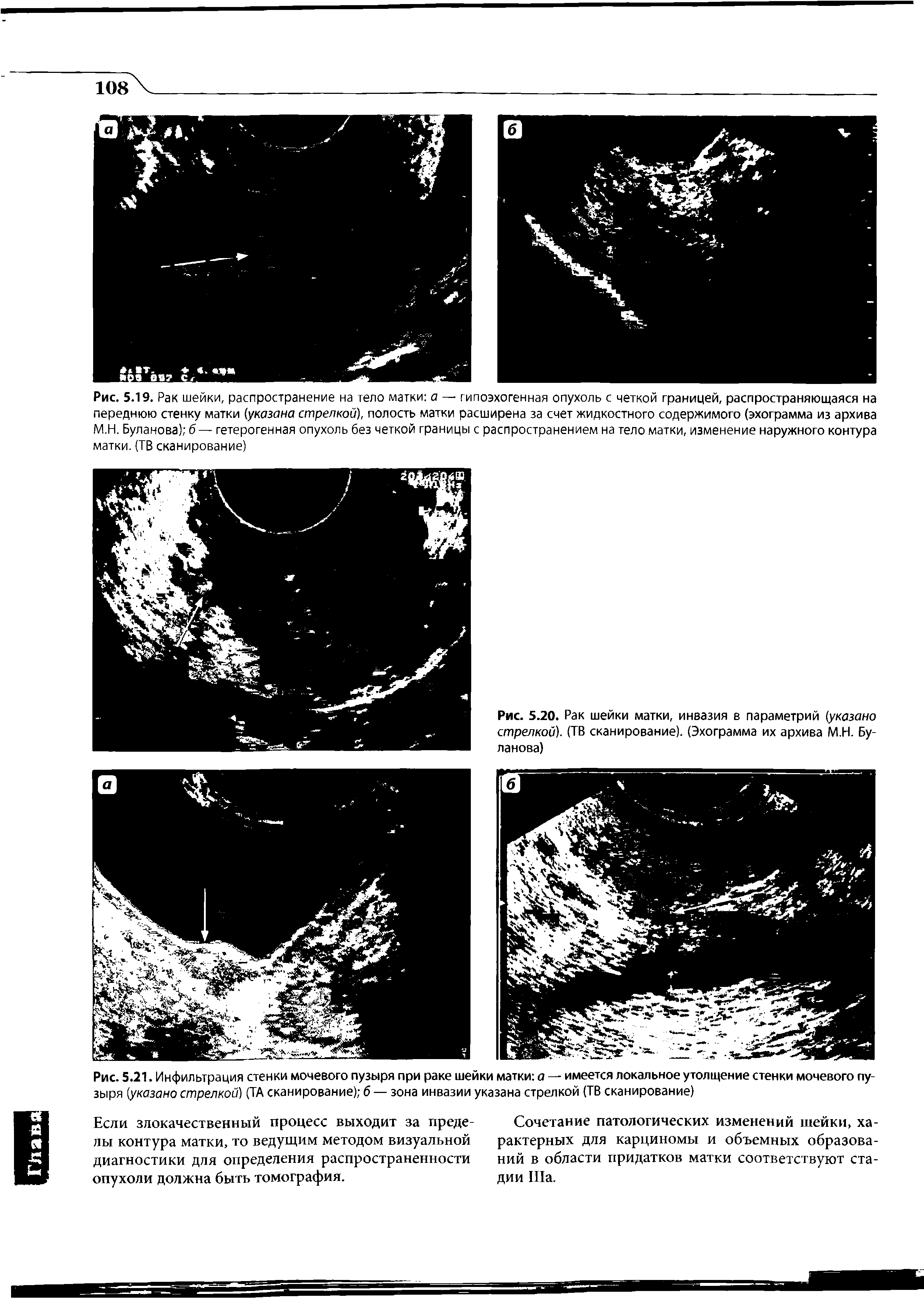 Рис. 5.21. Инфильтрация стенки мочевого пузыря при раке шейки матки а — имеется локальное утолщение стенки мочевого пузыря (указано стрелкой) (ТА сканирование) б — зона инвазии указана стрелкой (ТВ сканирование)...