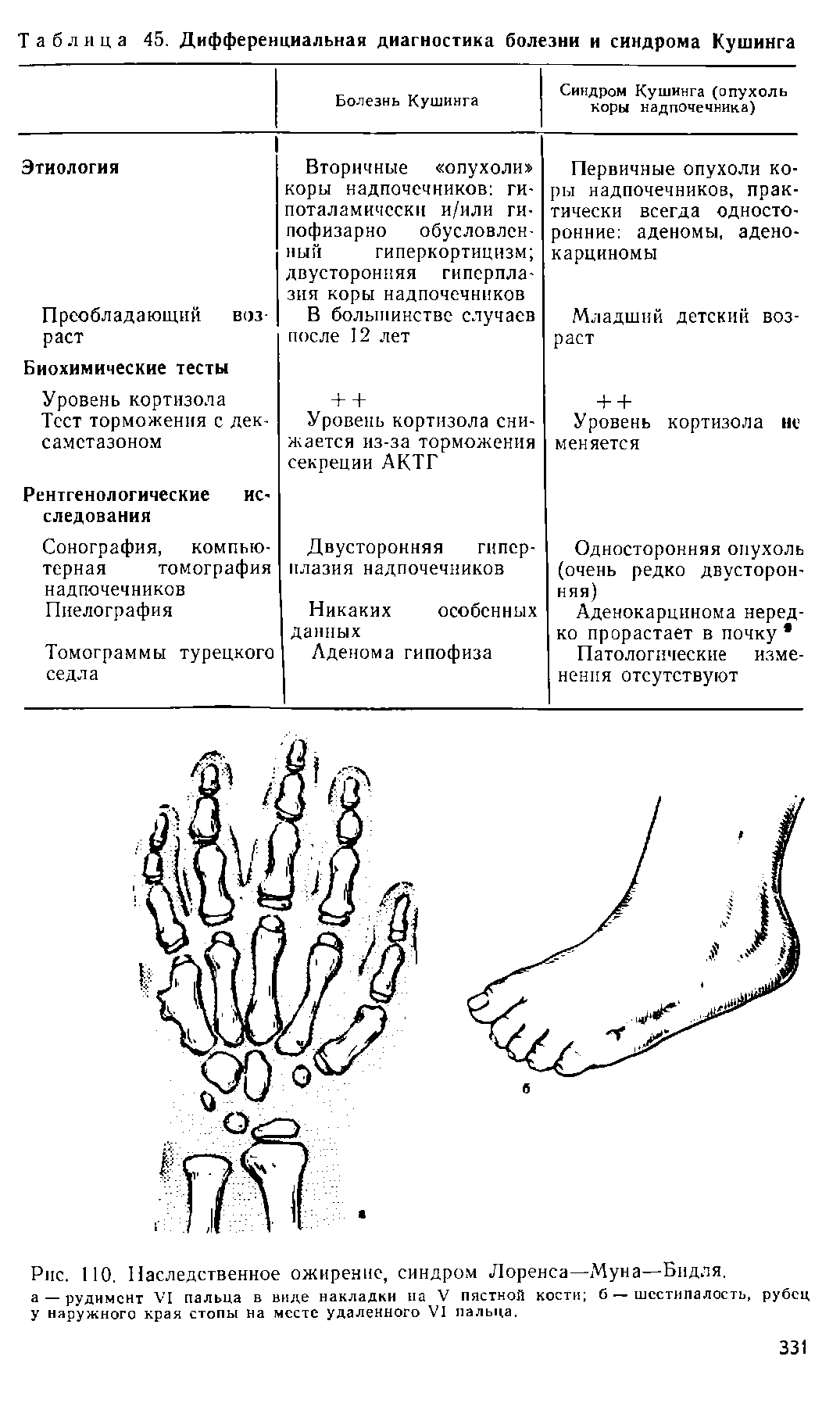 Рис. НО. Наследственное ожирение, синдром Лоренса—Муна—Билля, а руДИМСНТ у пальца в виде накладки на V пястной кости б — шестипалость, рубец у наружного края стопы на месте удаленного VI пальца,...