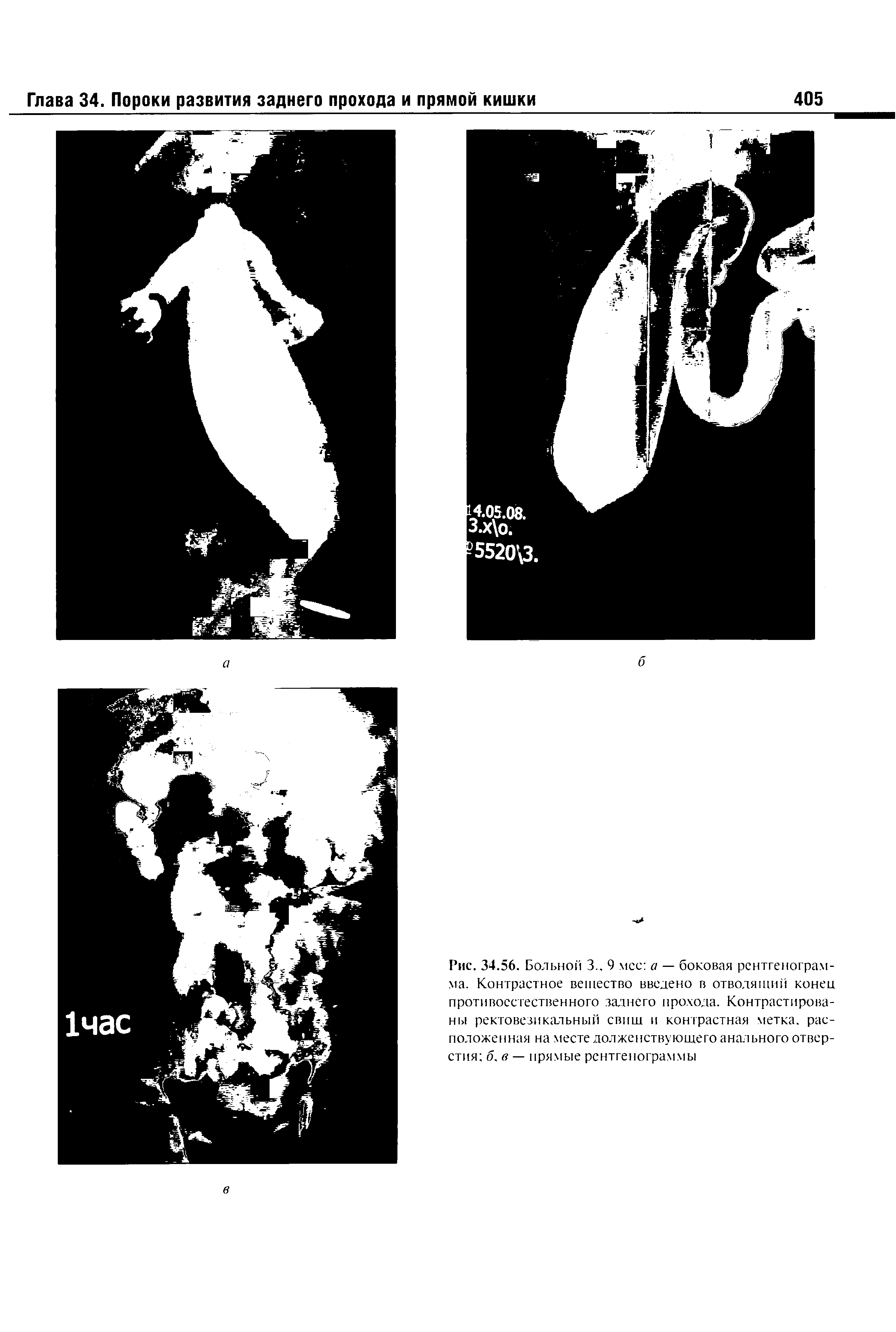 Рис. 34.56. Больной 3., 9 мсс а — боковая рентгенограмма. Контрастное вещество введено в отводящий конец противоестественного заднего прохода. Контрастированы ректовезикальный свищ и контрастная метка, расположенная на месте долженствующего анального отверстия б, в — прямые рентгенограммы...