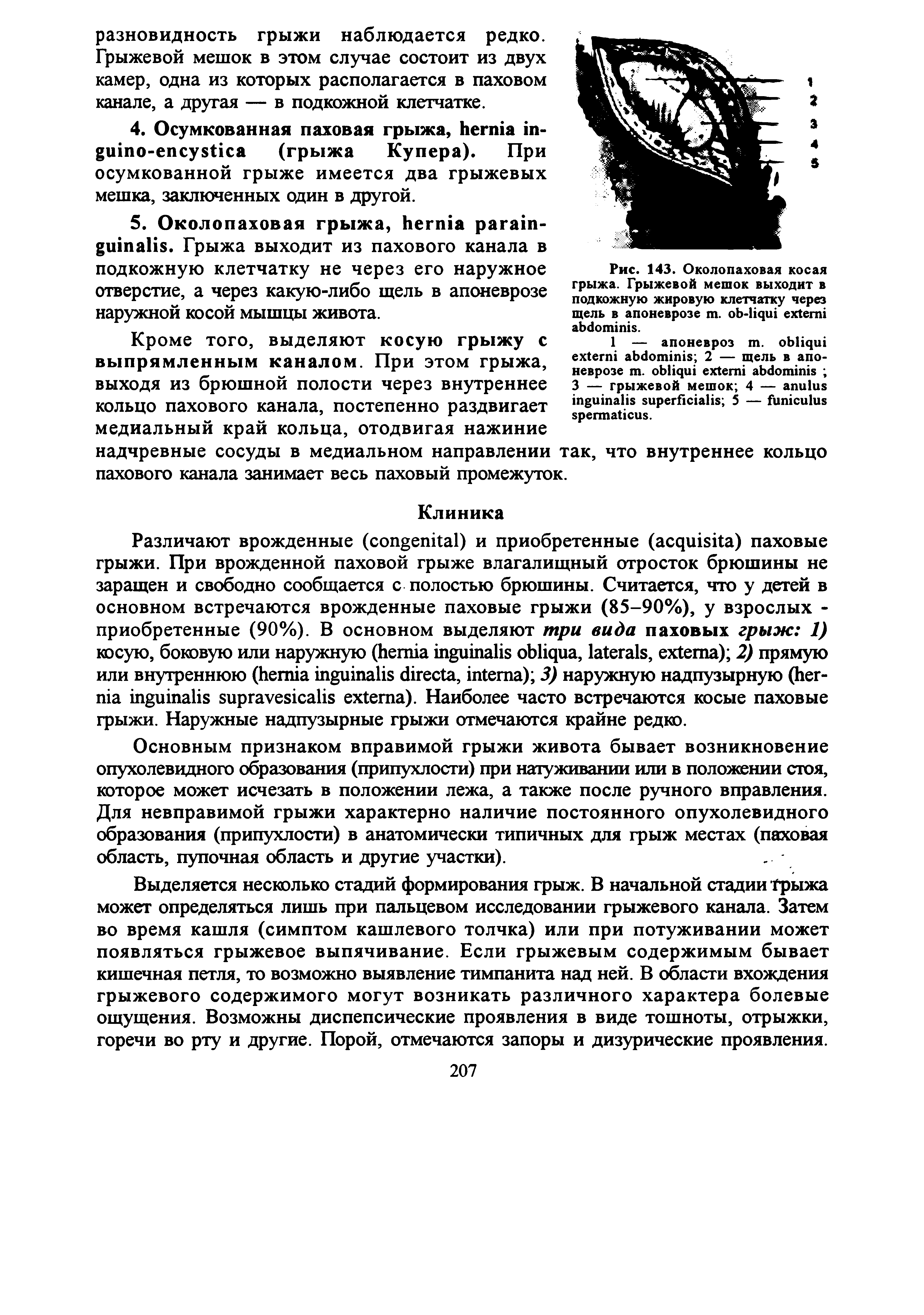 Рис. 143. Околопаховая косая грыжа. Грыжевой мешок выходит в подкожную жировую клетчатку через щель в апоневрозе . - .