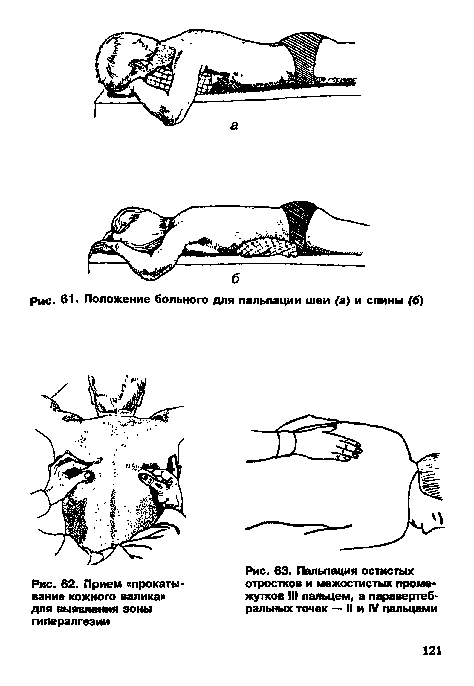Рис. 62. Прием прокатывание кожного валика для выявления зоны гипералгезии...