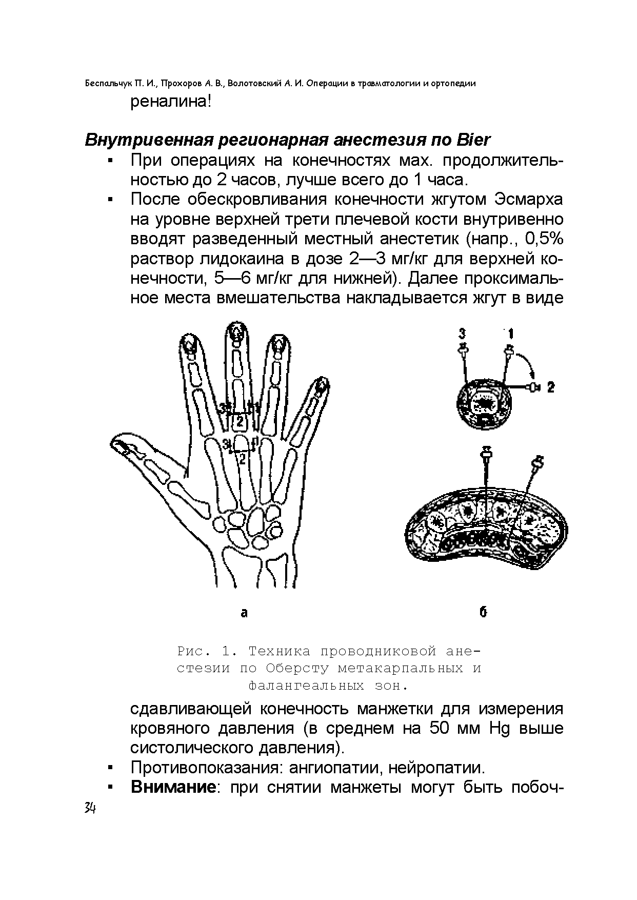 Рис. 1. Техника проводниковой анестезии по Оберсту метакарпальных и Фалангеальных зон.