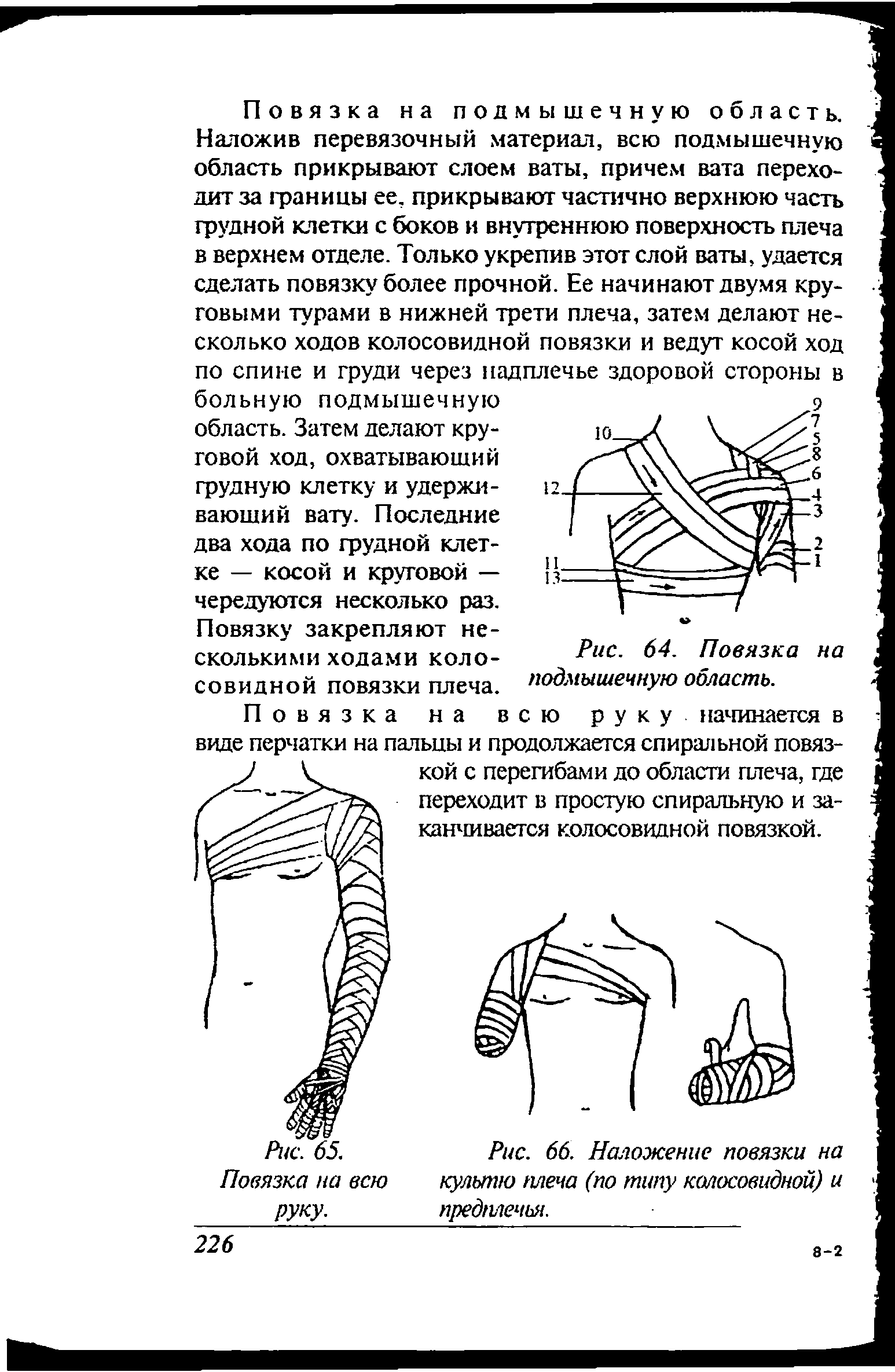 Рис. 66. Наложение повязки на культю плеча (по типу колосовидной) и предплечья.