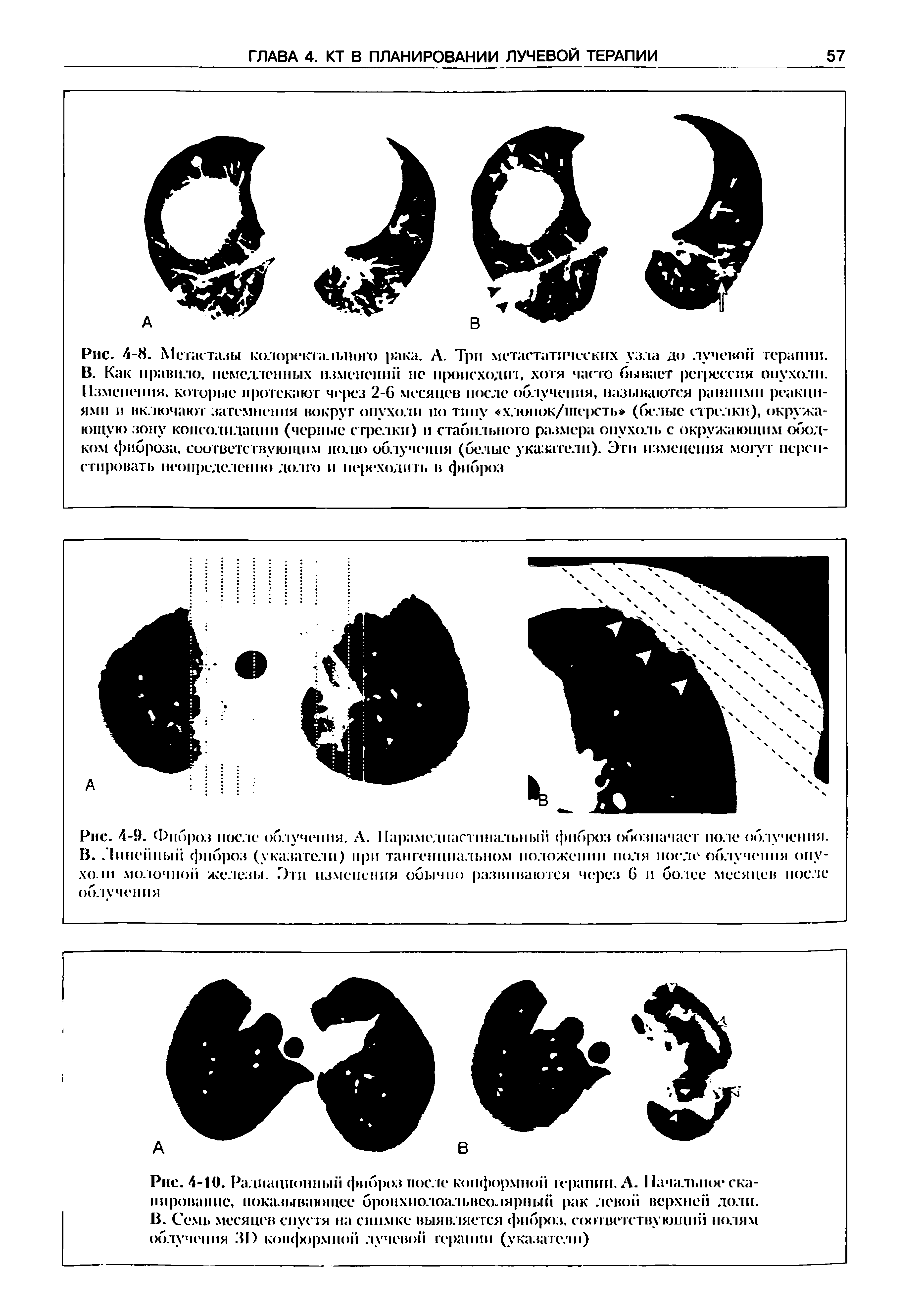 Рис. 4-9. Фиброз после облучения. А. Парамедпастинальный фиброз обозначает поле облучения. В. Линейный фиброз (указатели) при тангенциальном положении поля после облучения опухоли молочной железы. Зги изменения обычно развиваются через 6 и более месяцев после облучения...