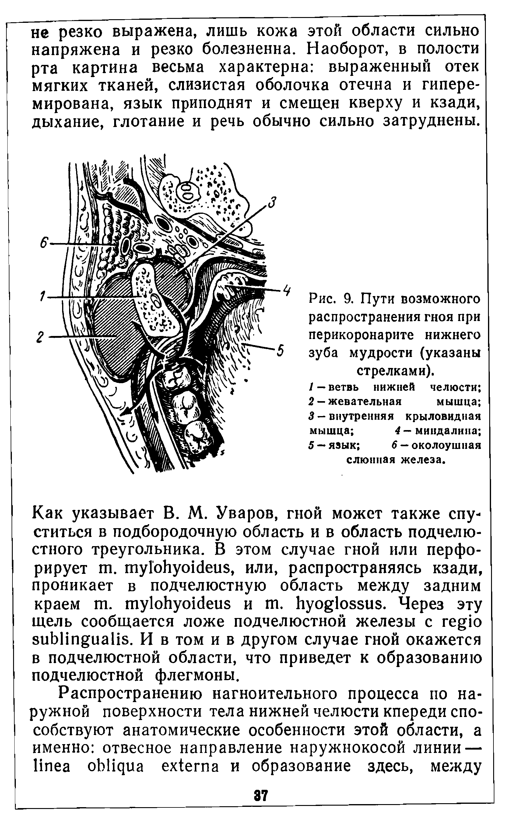 Рис. 9. Пути возможного распространения гноя при перикоронарите нижнего зуба мудрости (указаны стрелками).