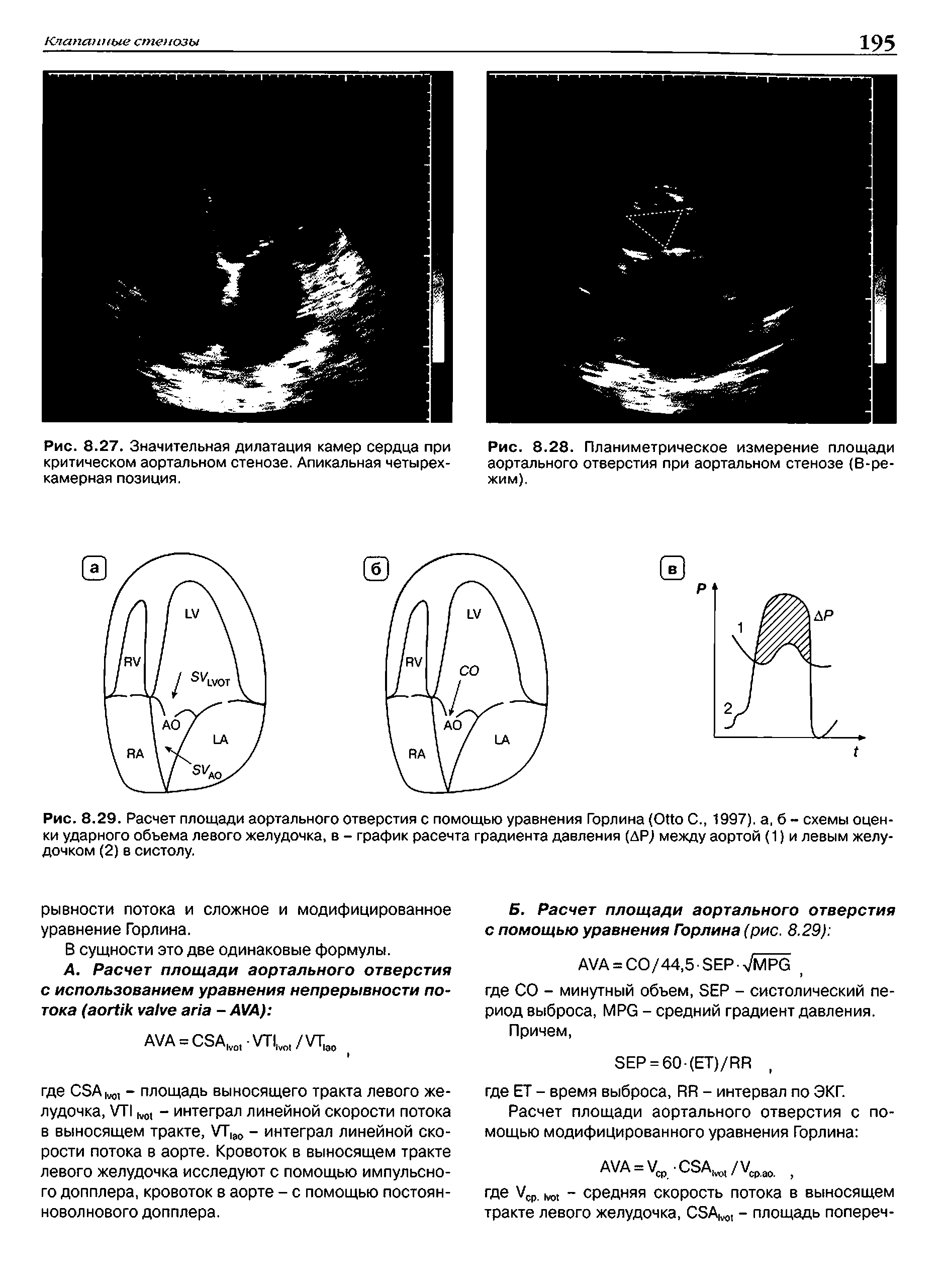 Рис. 8.29. Расчет площади аортального отверстия с помощью уравнения Горлина (O С., 1997). а, б - схемы оценки ударного объема левого желудочка, в - график расечта градиента давления (др) между аортой (1) и левым желудочком (2) в систолу.
