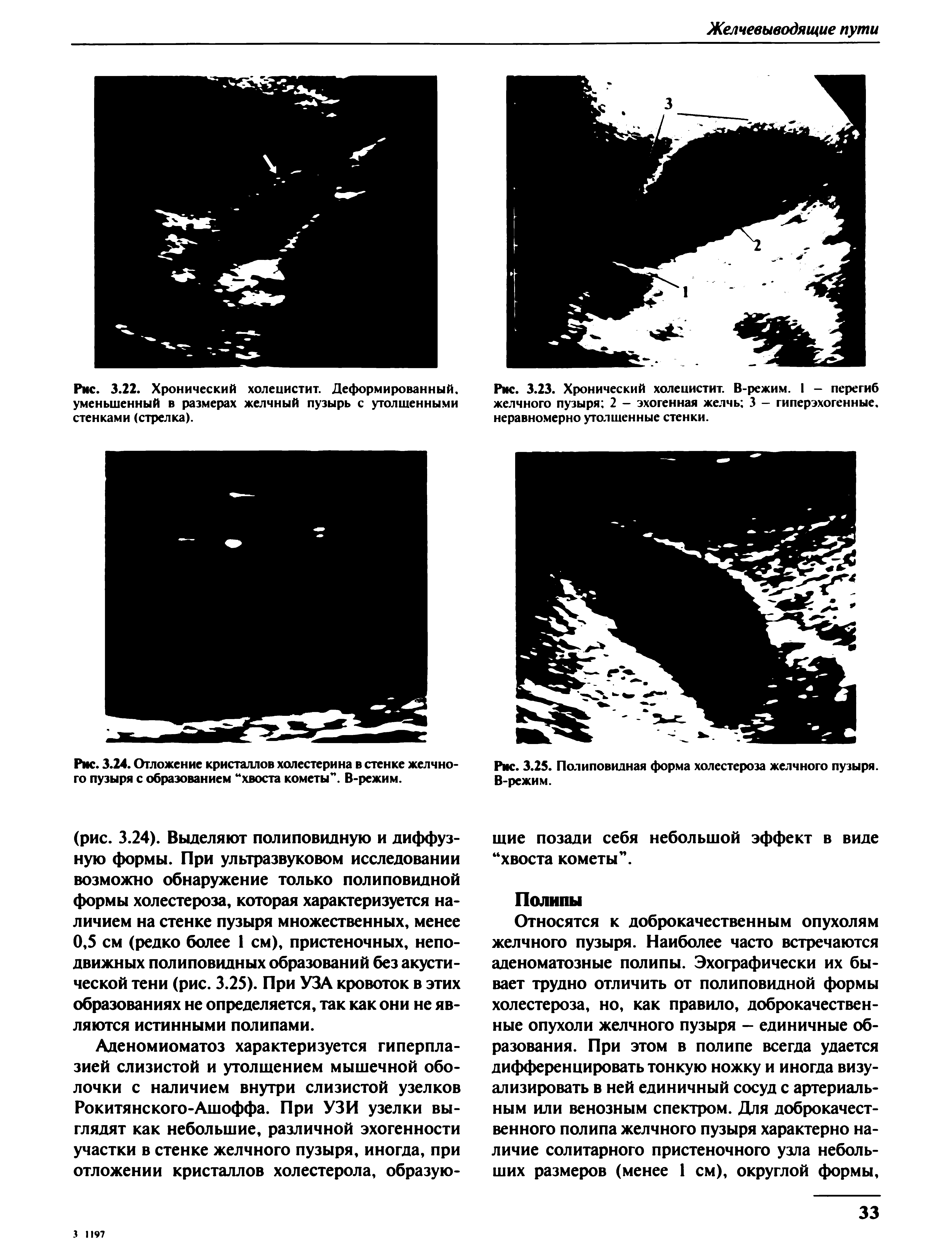 Рис. 3.23. Хронический холецистит. В-режим. I - перегиб желчного пузыря 2 - эхогенная желчь 3 - гиперэхогенные, неравномерно утолщенные стенки.