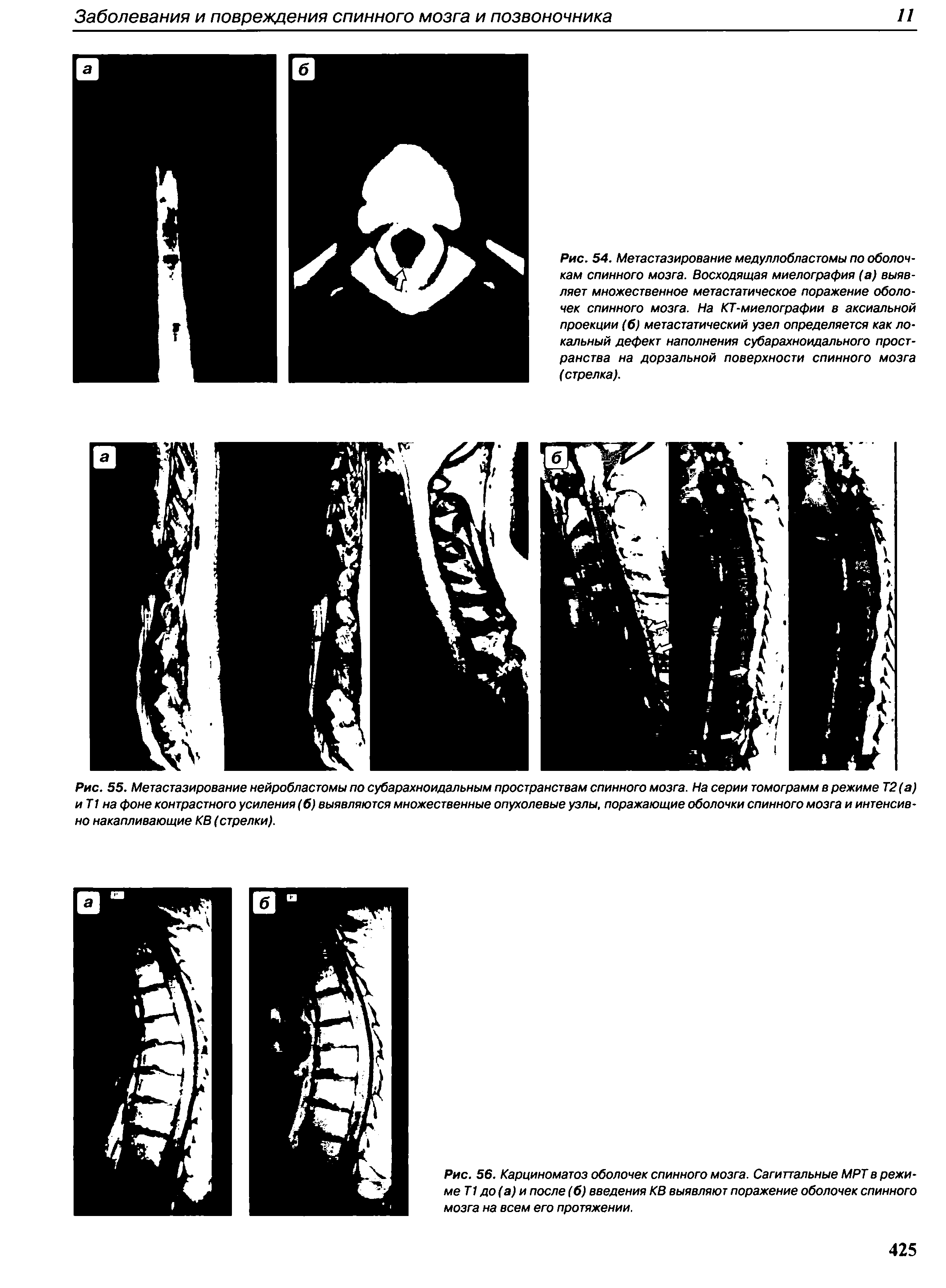 Рис. 55. Метастазирование нейробластомы по субарахноидальным пространствам спинного мозга. На серии томограмм в режиме Т2(а) иТ1 на фоне контрастного усиления (б) выявляются множественные опухолевые узлы, поражающие оболочки спинного мозга и интенсивно накапливающие КВ (стрелки).