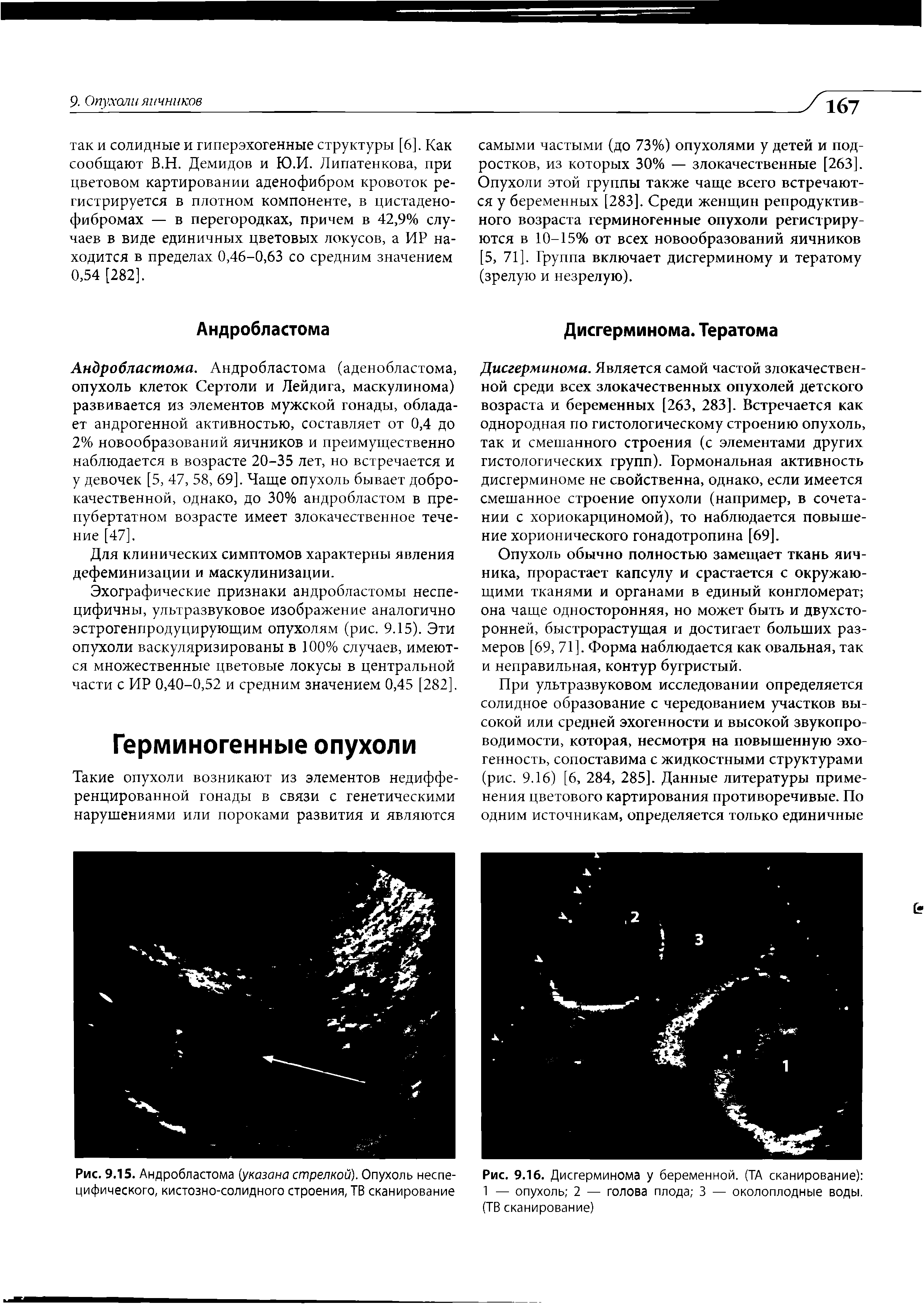 Рис. 9.15. Андробластома (указана стрелкой). Опухоль неспецифического, кистозно-солидного строения, ТВ сканирование...