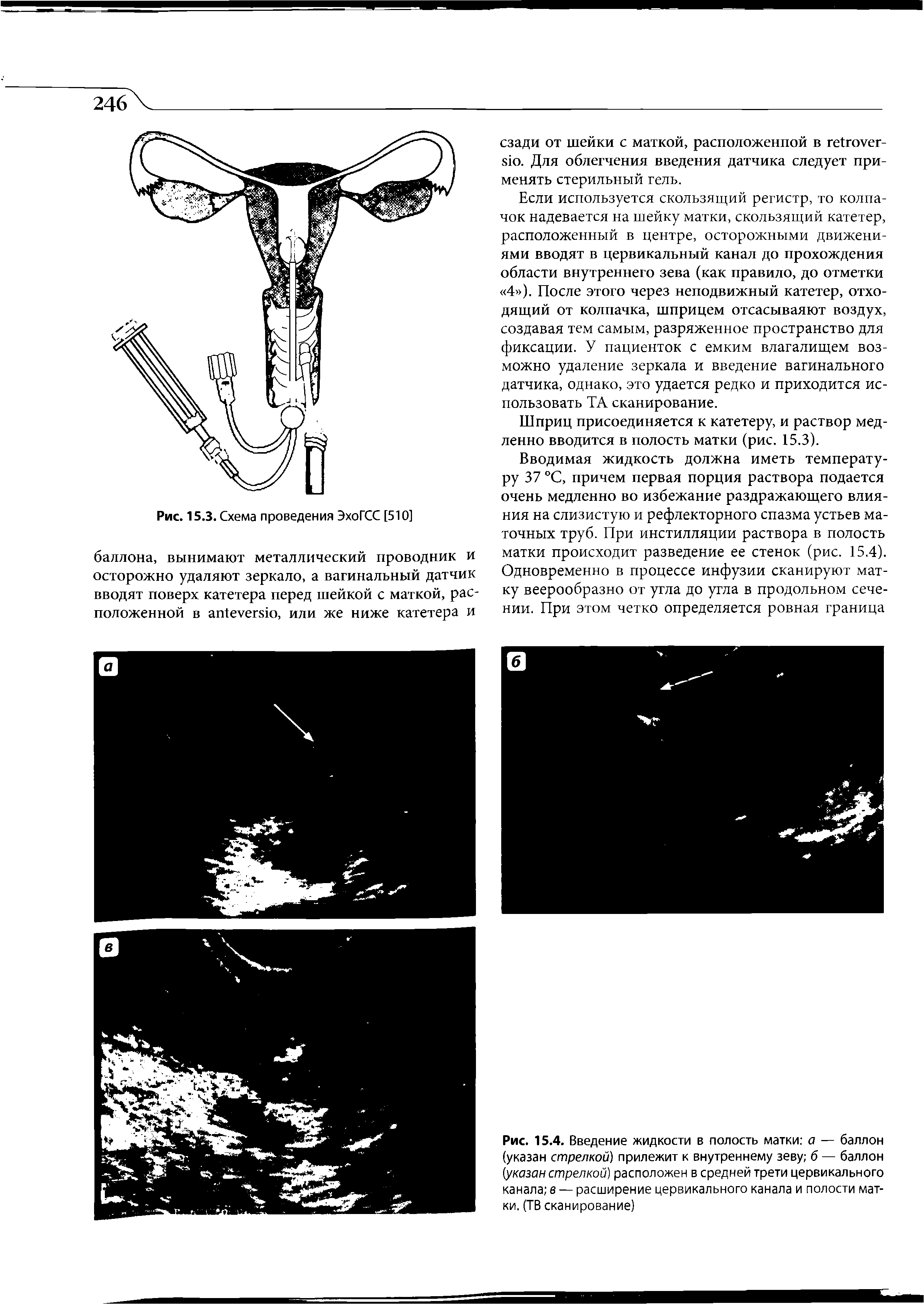 Рис. 15.4. Введение жидкости в полость матки а — баллон (указан стрелкой прилежит к внутреннему зеву б — баллон (указан стрелкой расположен в средней трети цервикального канала в — расширение цервикального канала и полости матки. (ТВ сканирование)...