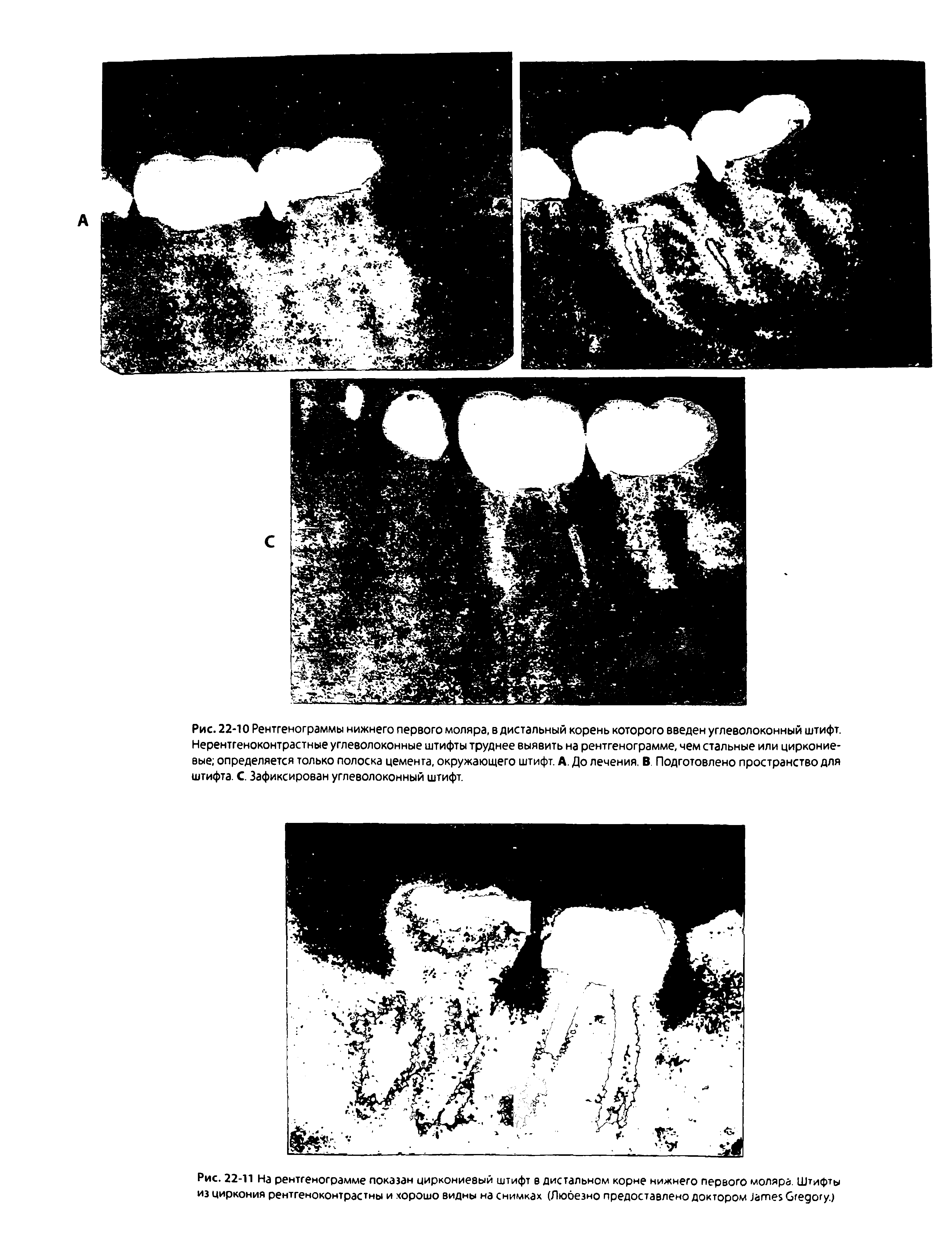 Рис. 22-10 Рентгенограммы нижнего первого моляра, в дистальный корень которого введен углеволоконный штифт. Нерентгеноконтрастные углеволоконные штифты труднее выявить на рентгенограмме, чем стальные или циркониевые определяется только полоска цемента, окружающего штифт. А. До лечения. В. Подготовлено пространство для штифта. С. Зафиксирован углеволоконный штифт.