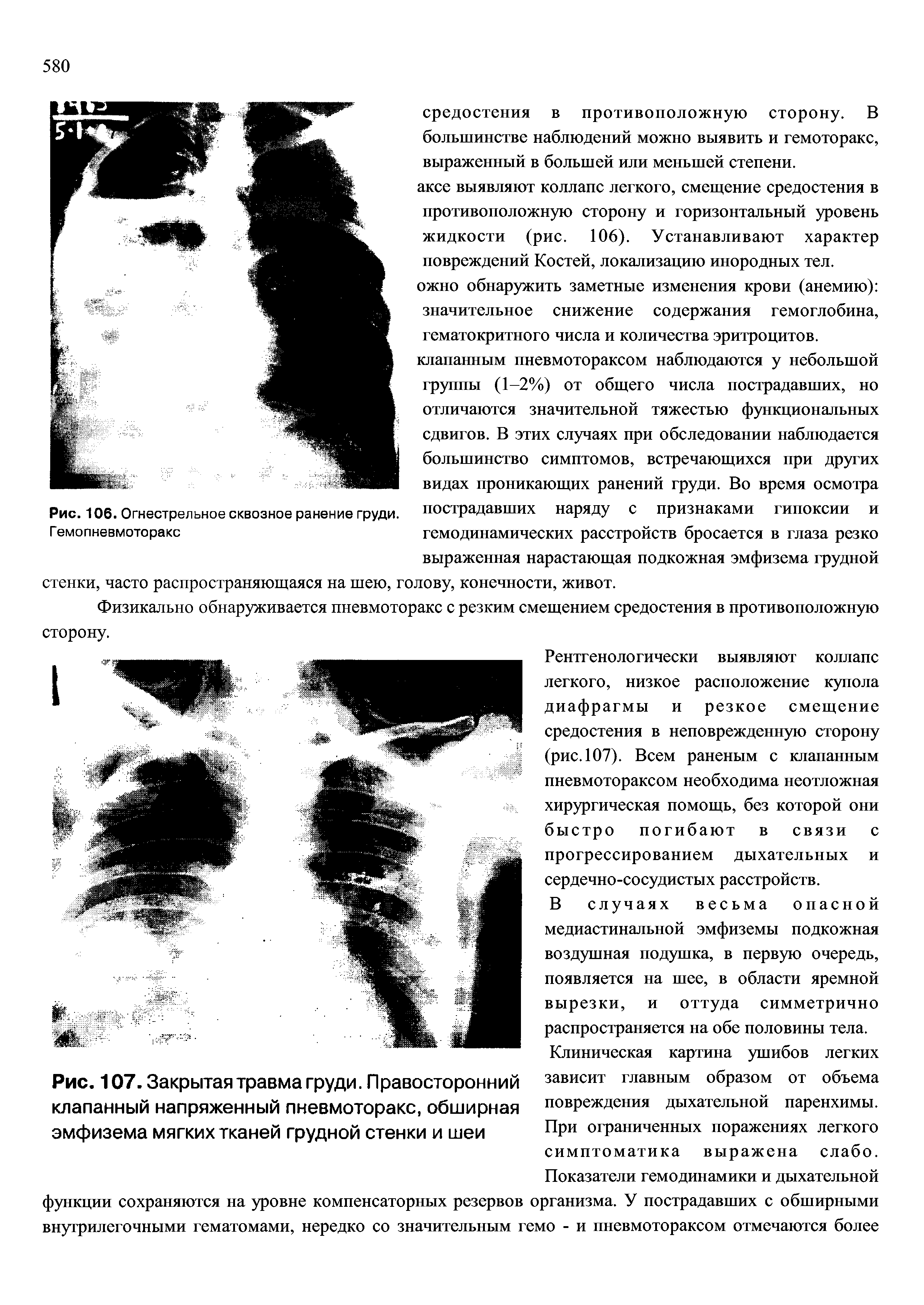 Рис. 107. Закрытая травма груди. Правосторонний клапанный напряженный пневмоторакс, обширная эмфизема мягких тканей грудной стенки и шеи...