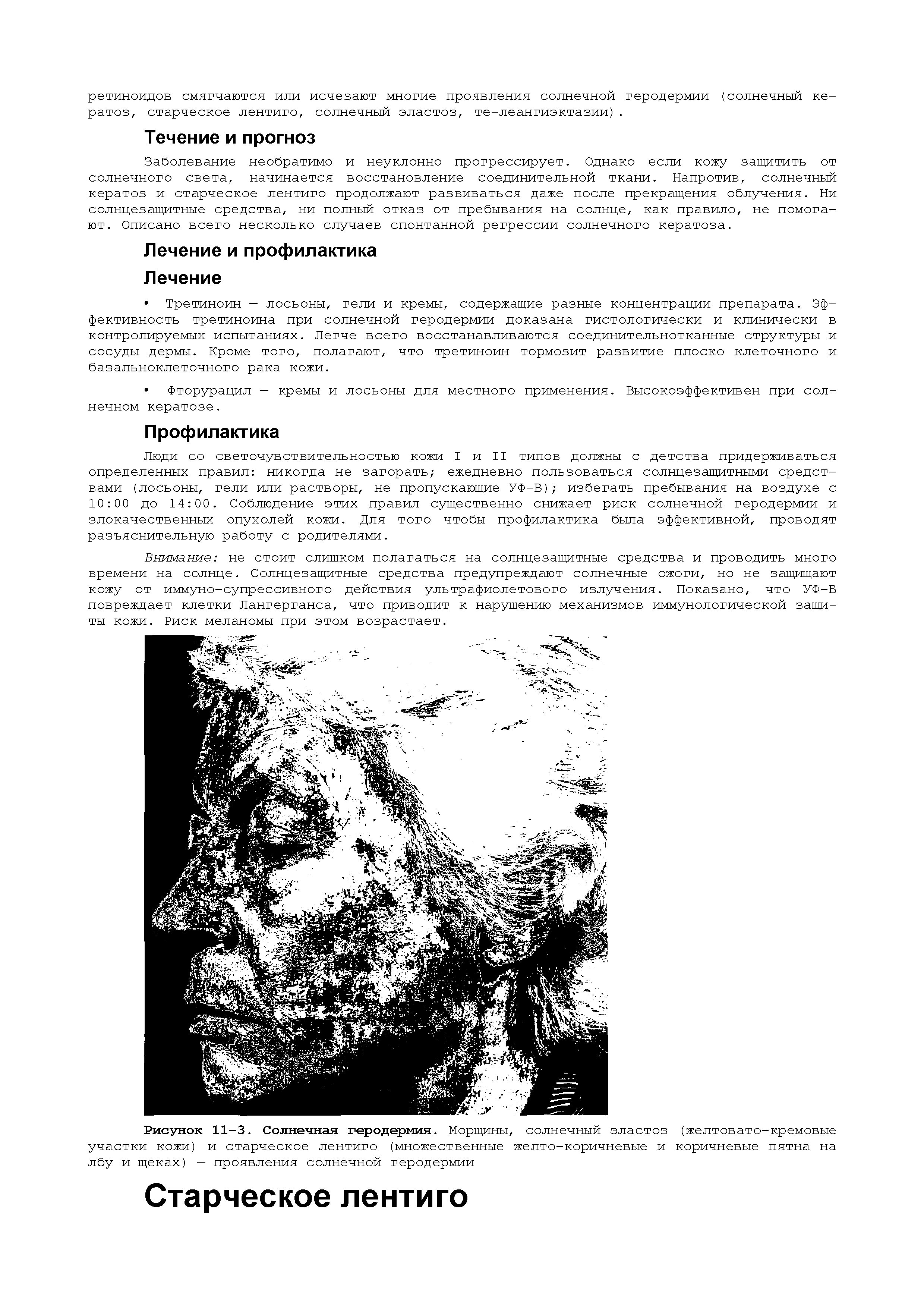 Рисунок 11-3. Солнечная геродермия. Морщины, солнечный эластоз (желтовато-кремовые участки кожи) и старческое лентиго (множественные желто-коричневые и коричневые пятна на лбу и щеках) — проявления солнечной геродермии...