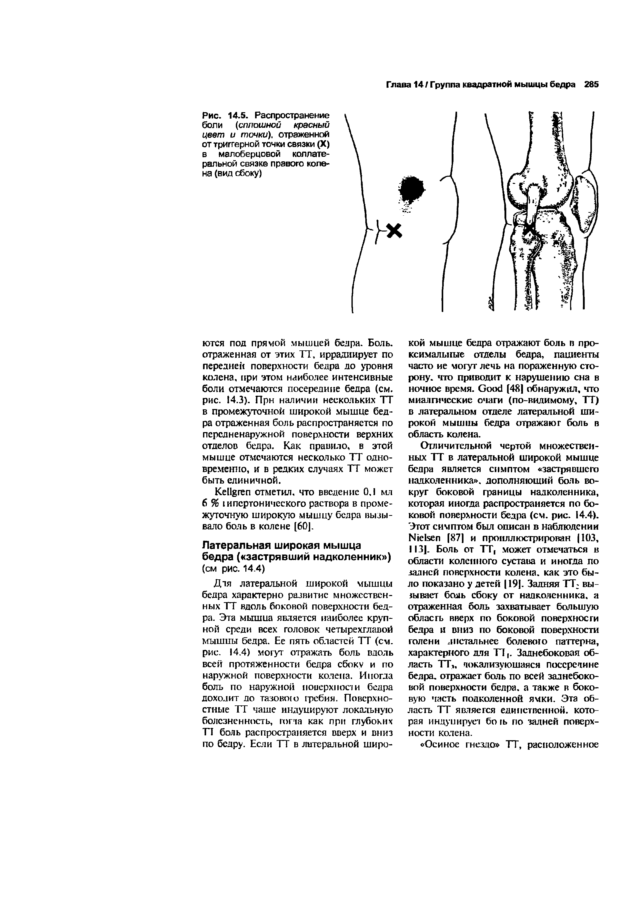 Рис. 14.5. Распространение боли (сплошной красный цвет и точки), отраженной от триггерной точки связки (X) в малоберцовой коллатеральной связке правого колена (вид сбоку)...