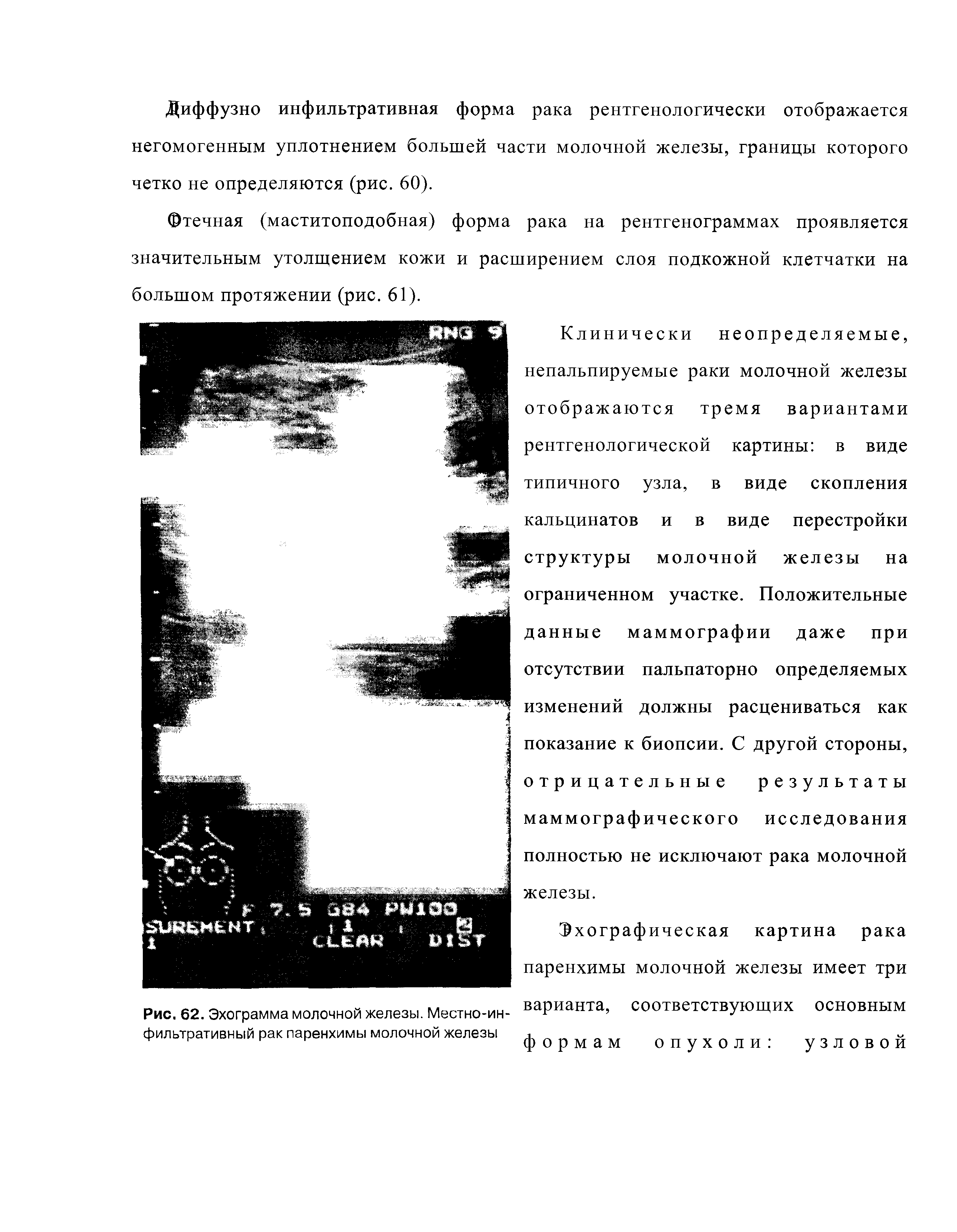 Рис. 62. Эхограмма молочной железы. Местно-ин- варианта, соответствующих основным фильтративный рак паренхимы молочной железы формам опухоли узловой...
