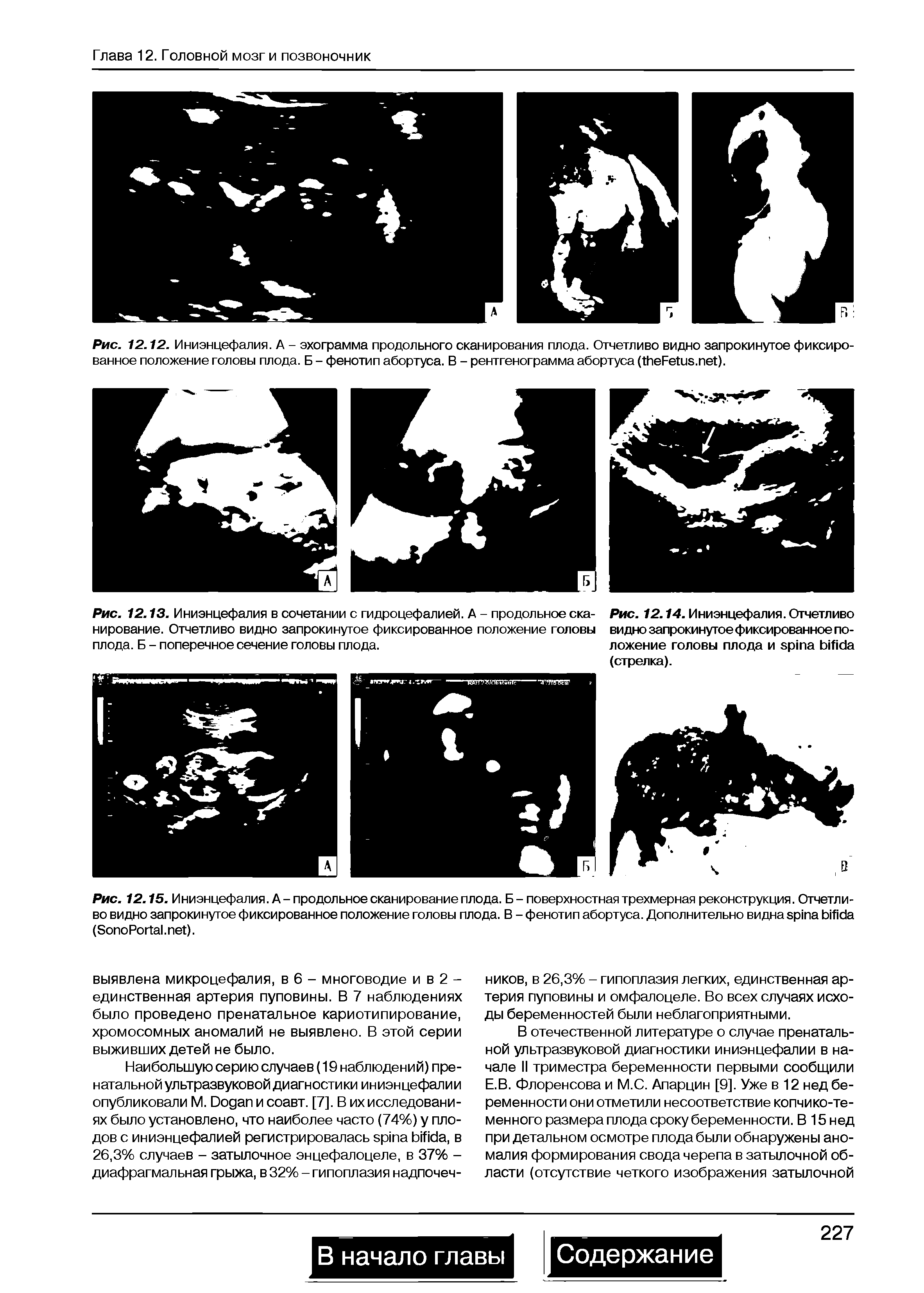 Рис. 12.14. Иниэнцефалия. Отчетливо видно запрокинутое фиксированное положение головы плода и (стрелка).