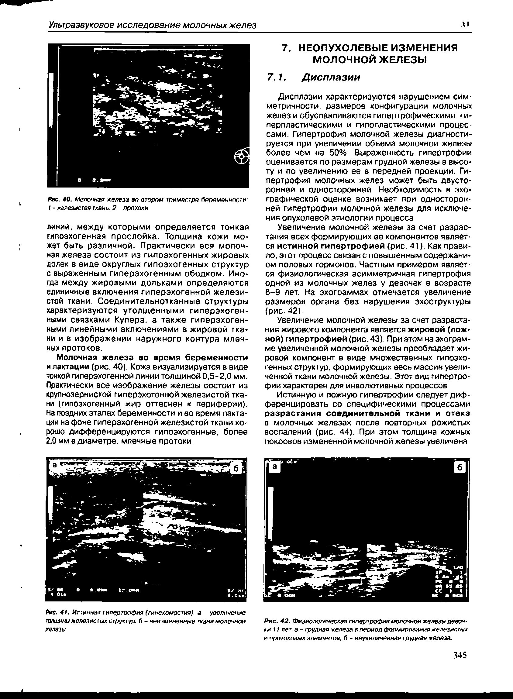 Рис. 42. Физиологическая гипертрофия молочной железы лееоч- и 11 пет. а - грудная железа а лериол формирования железистых и OKT апеменцш. б - неунеличянная трудная желала.