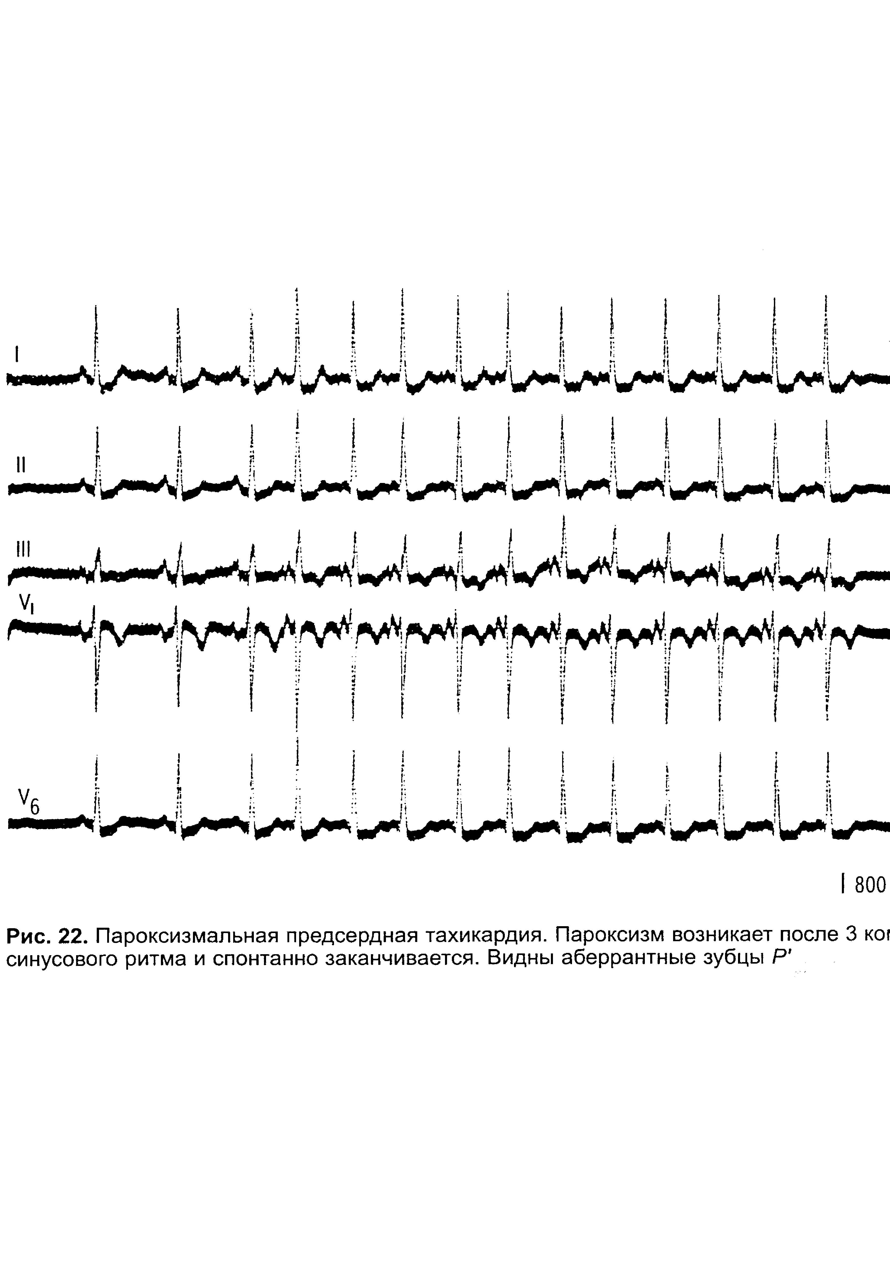 Рис. 22. Пароксизмальная предсердная тахикардия. Пароксизм возникает после 3 ко1 синусового ритма и спонтанно заканчивается. Видны аберрантные зубцы Р ...