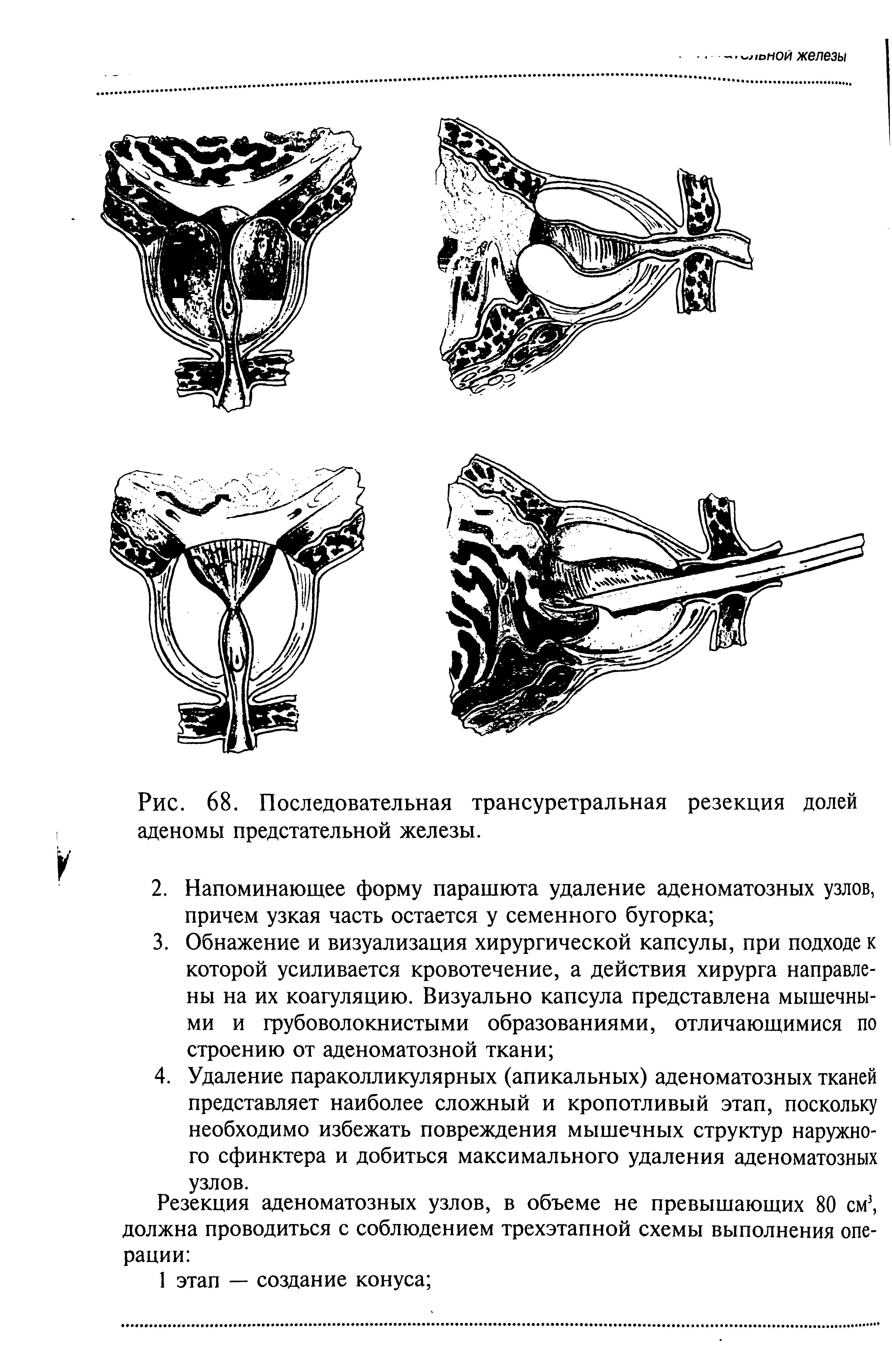 Рис. 68. Последовательная трансуретральная резекция долей аденомы предстательной железы.