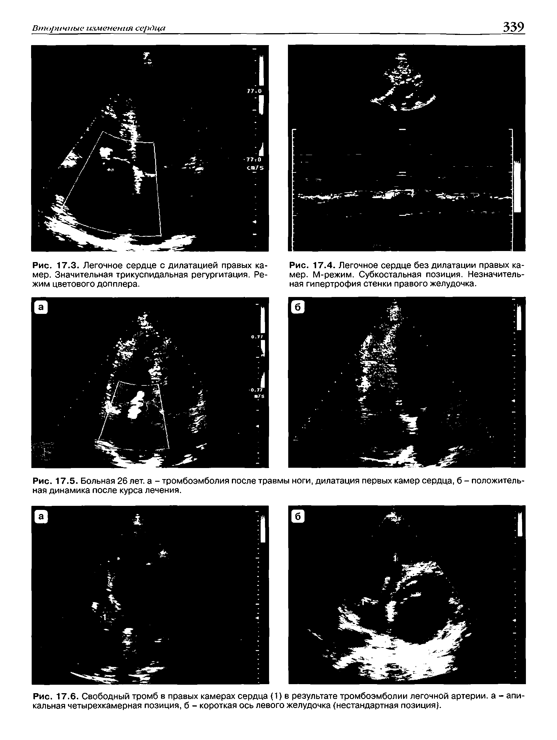 Рис. 17.5. Больная 26 лет. а - тромбоэмболия после травмы ноги, дилатация первых камер сердца, б - положителы ная динамика после курса лечения.