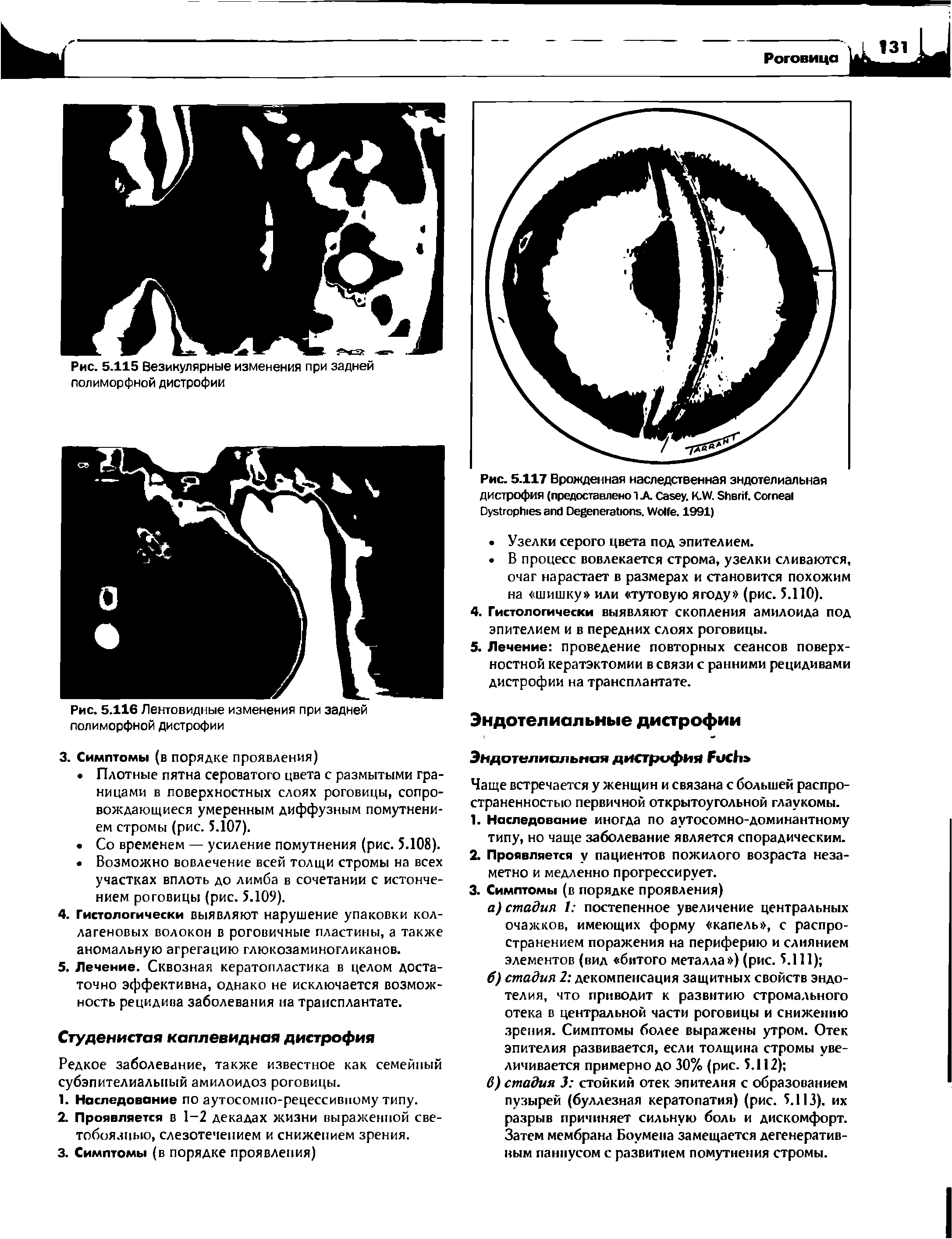 Рис. 5.117 Врожденная наследственная эндотелиальная дистрофия (предоставлено 1A C . K.W. S . C D D . W . 1991)...