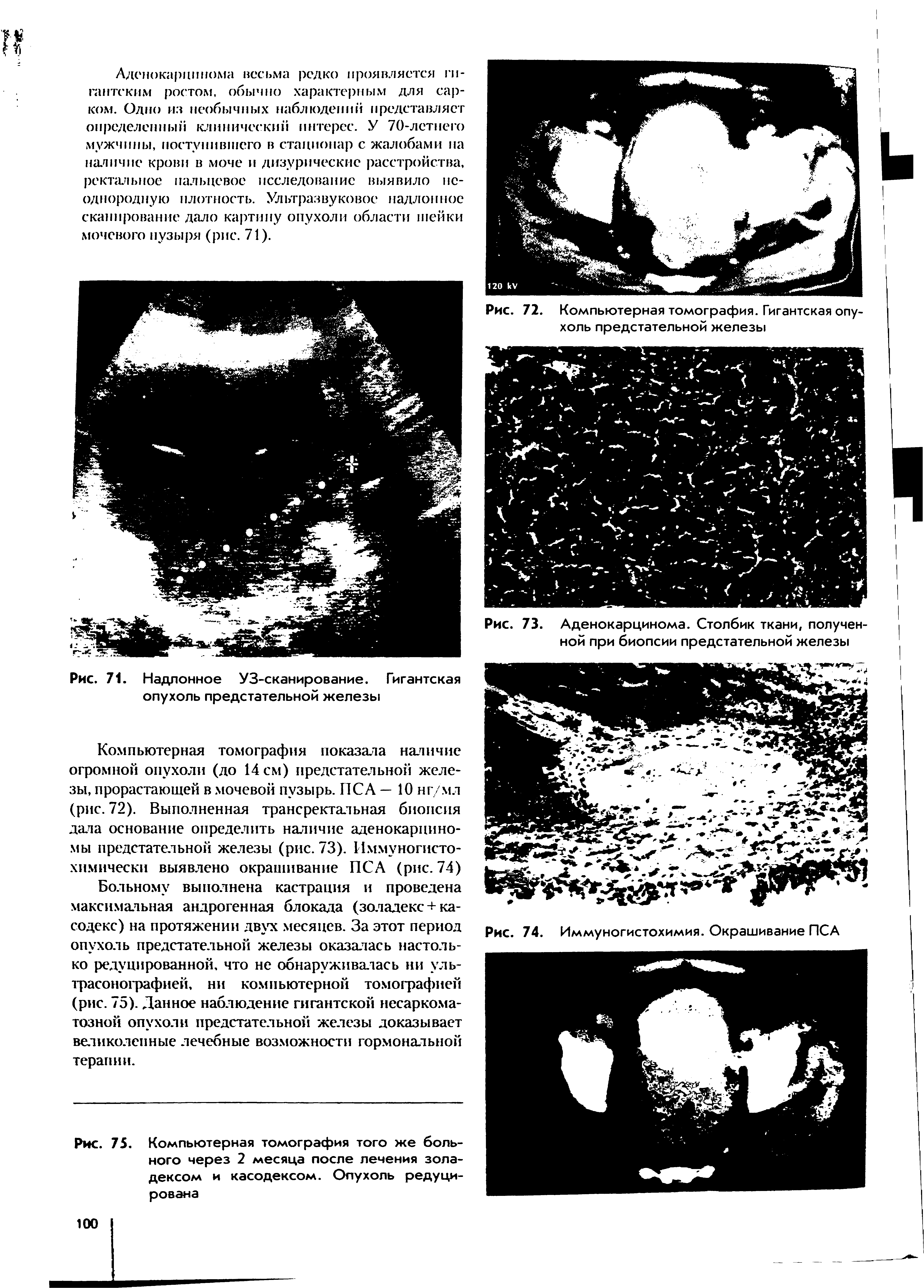 Рис. 72. Компьютерная томография. Гигантская опухоль предстательной железы...