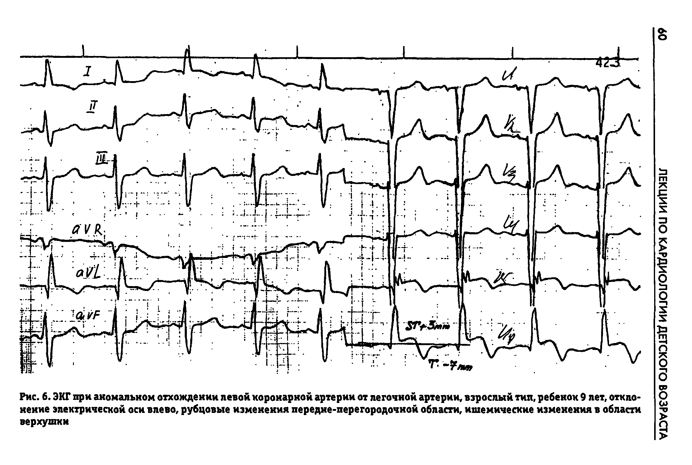 Рис. 6. ЭКГ при аномальном отхождении левой коронарной артерии от легочной артерии, взрослый тип, ребенок 9 лет, отклонение электрической оси влево, рубцовые изменения передне-перегородочной области, ишемические изменения в области верхушки...