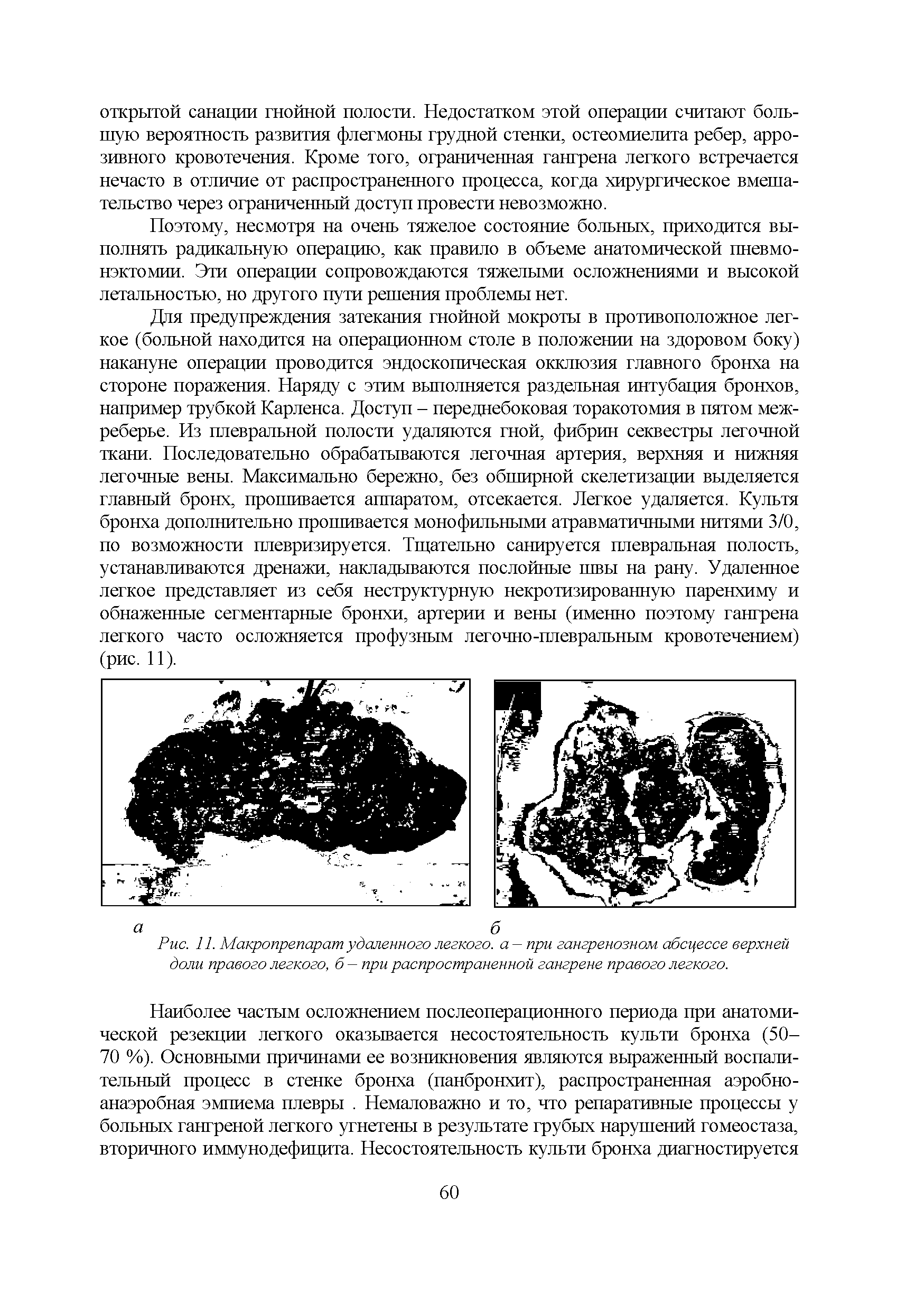 Рис. 11. Макропрепарат удаленного легкого, а — при гангренозном абсцессе верхней доли правого легкого, б — при распространенной гангрене правого легкого.