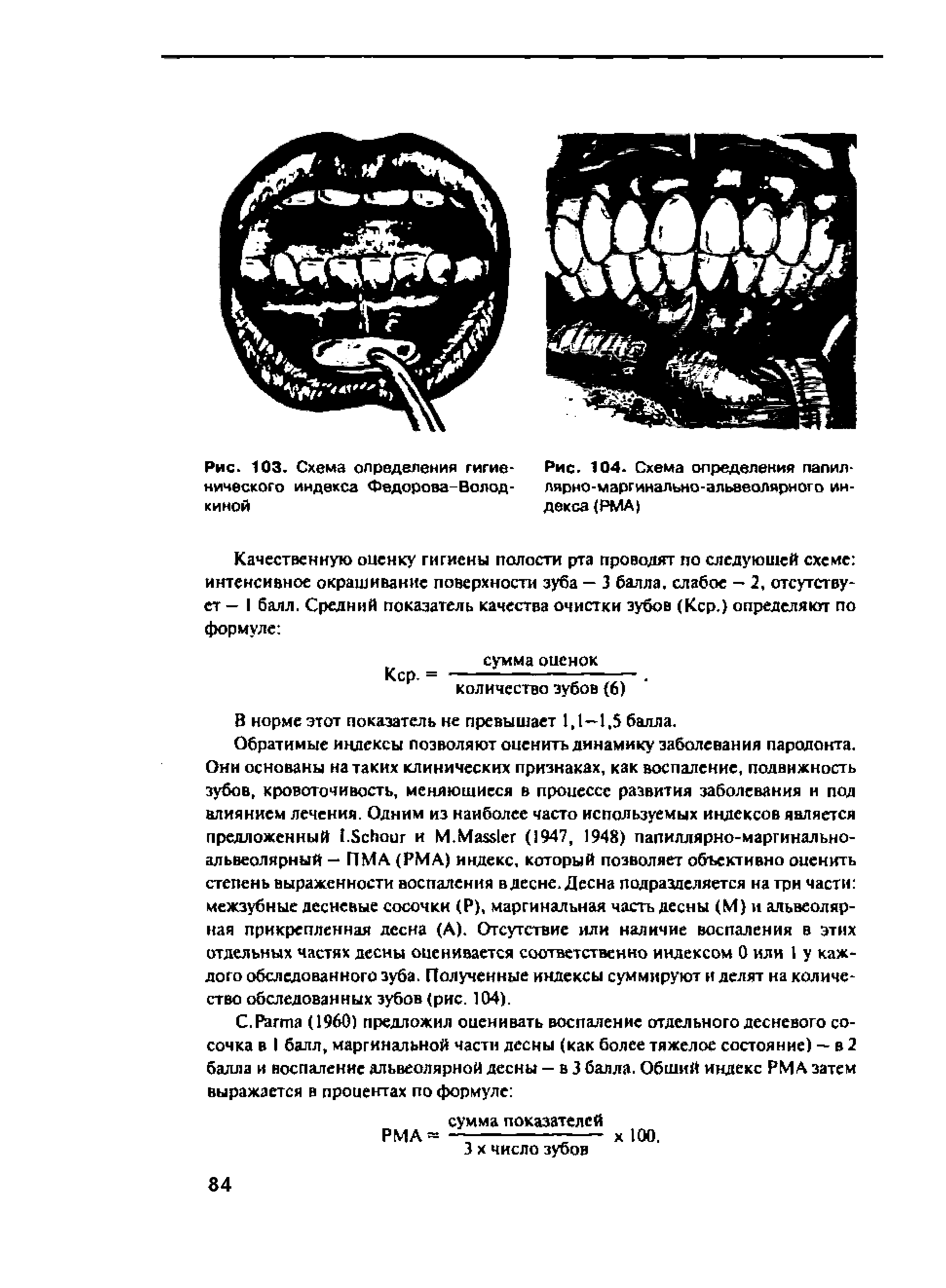 Рис. 104. Схема определения папиллярно-маргинально-альвеолярного индекса (РМА ...