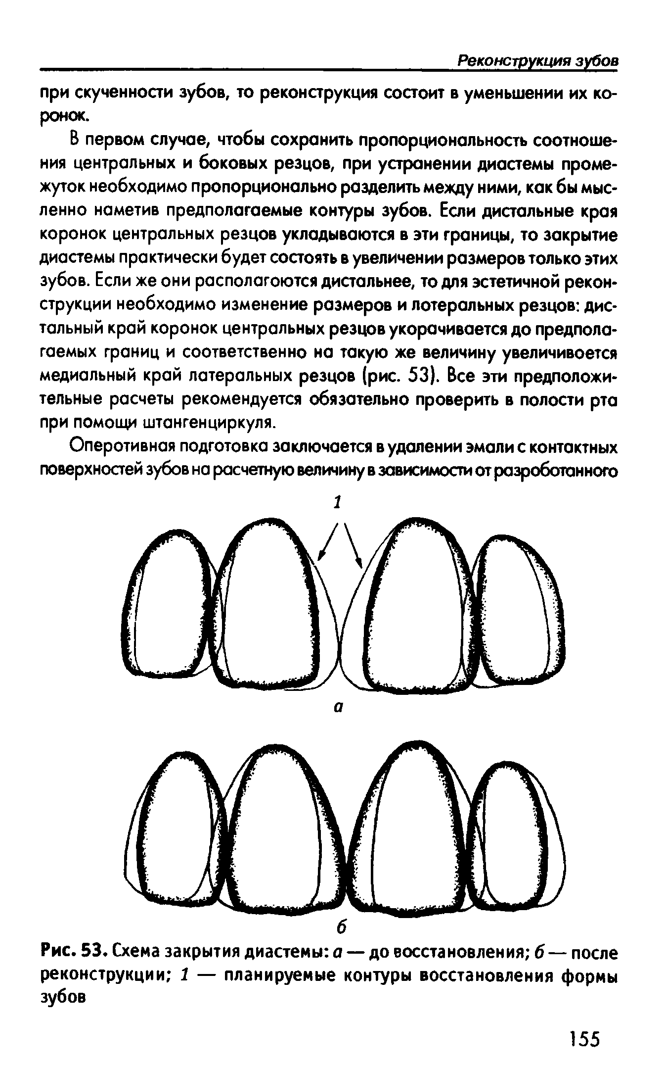 Рис. 53. Схема закрытия диастемы а — до восстановления б — после реконструкции 1 — планируемые контуры восстановления формы зубов...